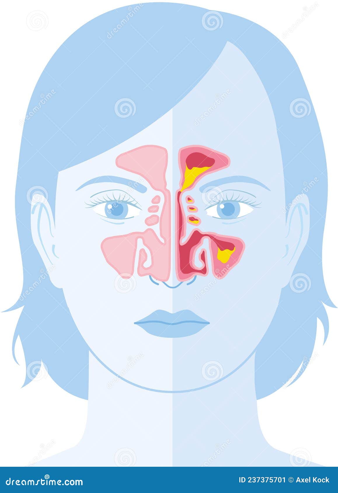Sinusitis Vector Illustration Stock Illustration Illustration Of