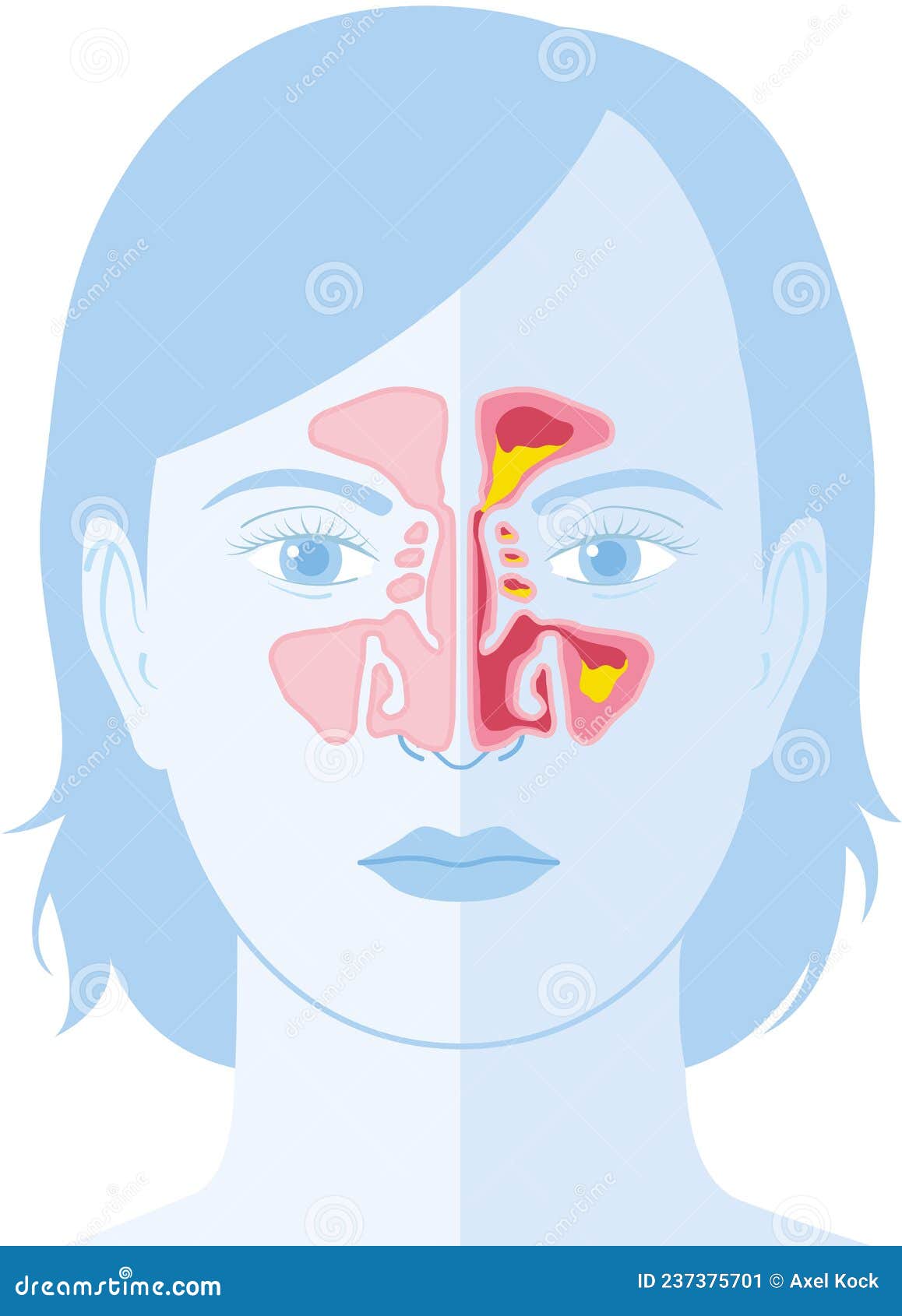 sinusitis,  