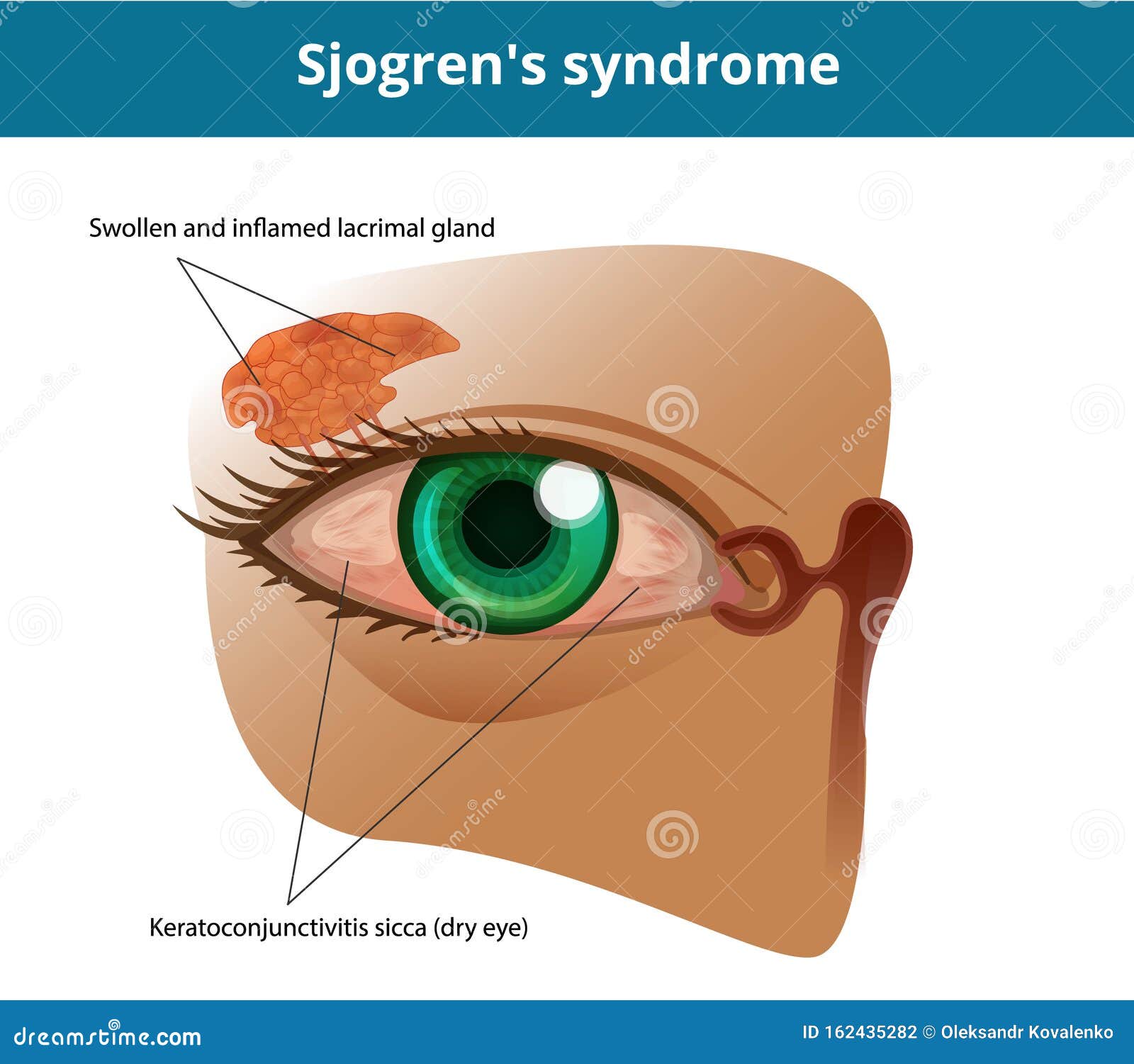 keratoconjunctivitis sicca sjogren's icd 10