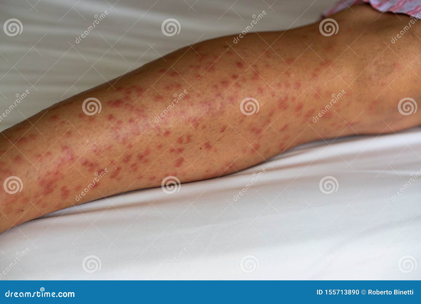 Skeeter`s Syndrome After Mosquitos Bite Stock Photo Image Of Care