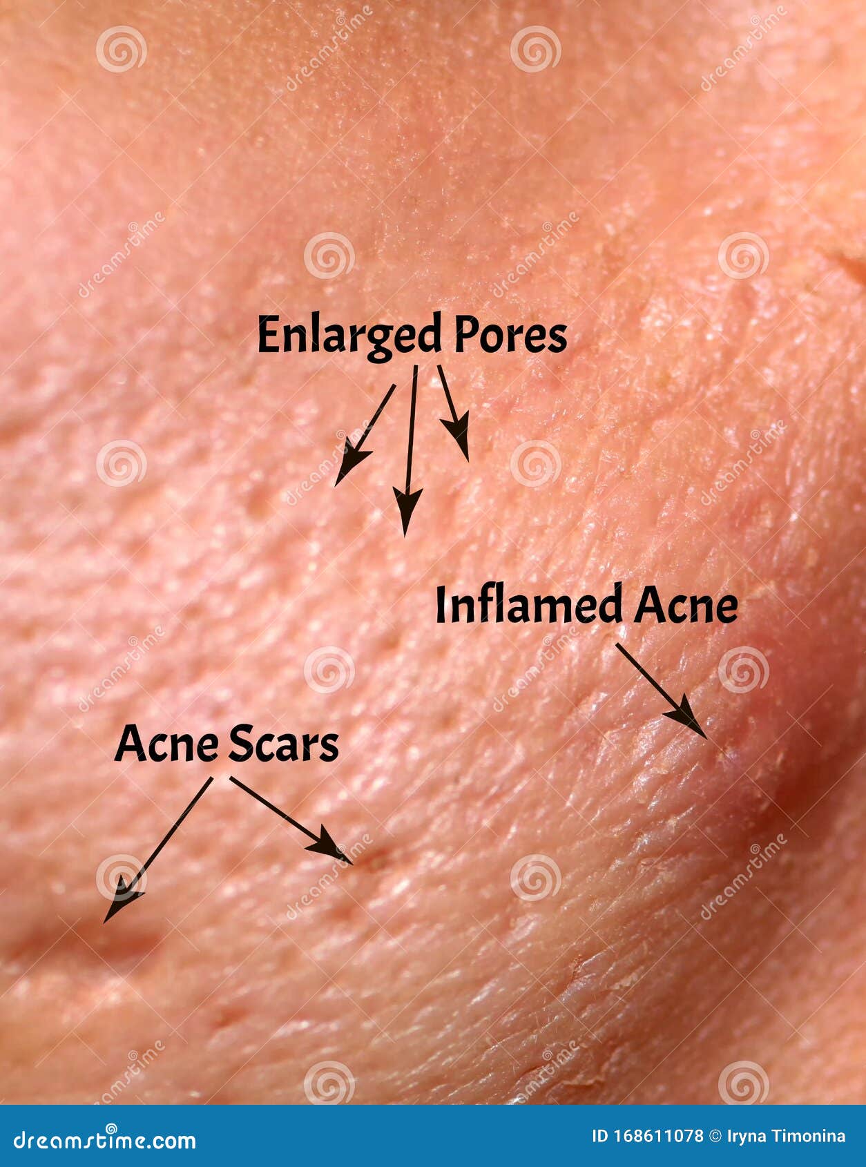 varicoza pimple