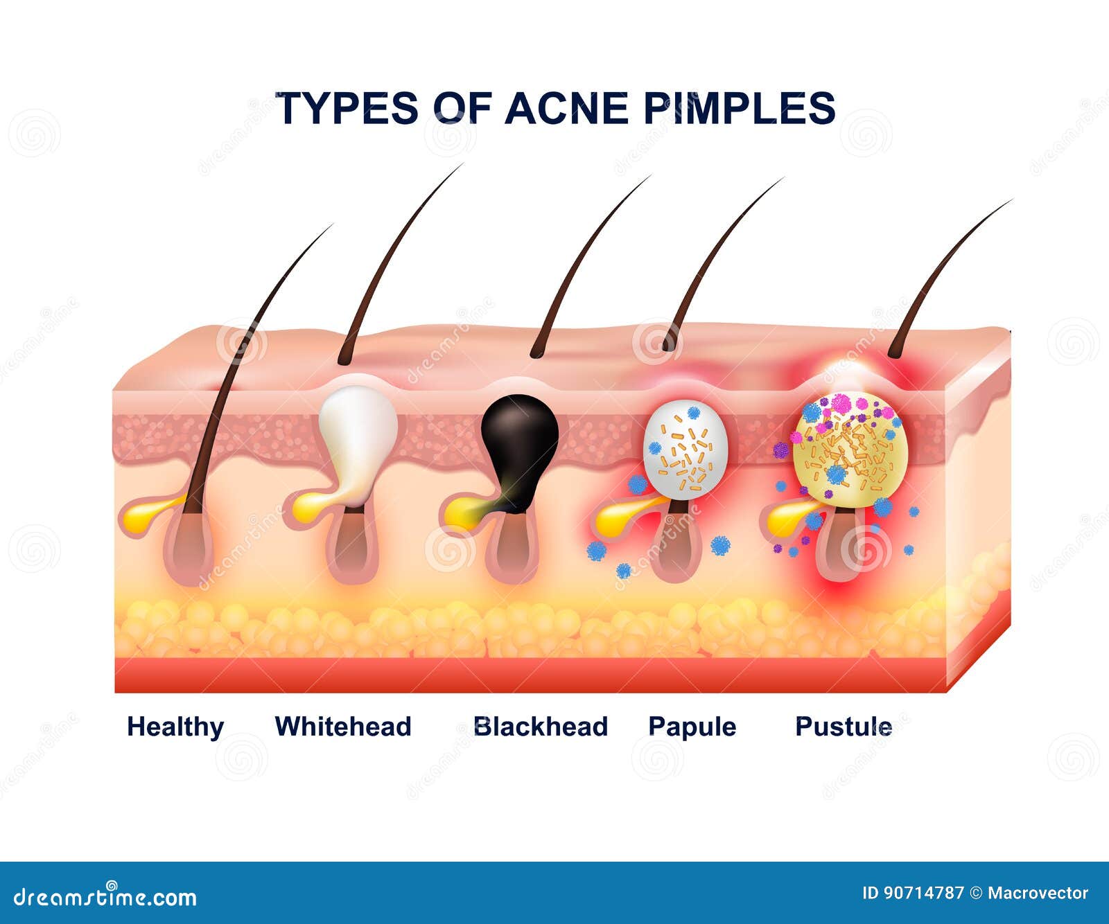 Skin Acne Anatomy Composition Stock Vector Illustration of medical