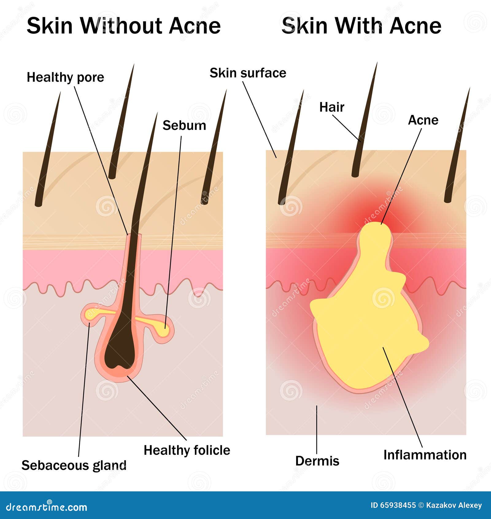 skin with and without acne