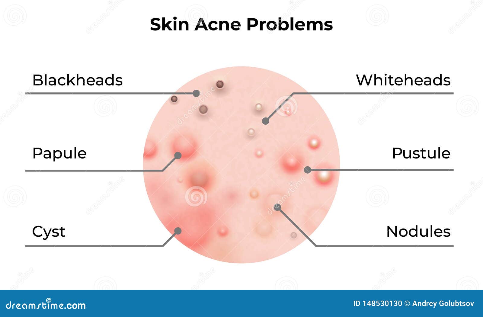 skin acne types diagram.  skin problems disease, pimples blackheads and comedones, cosmetology skincare treatment