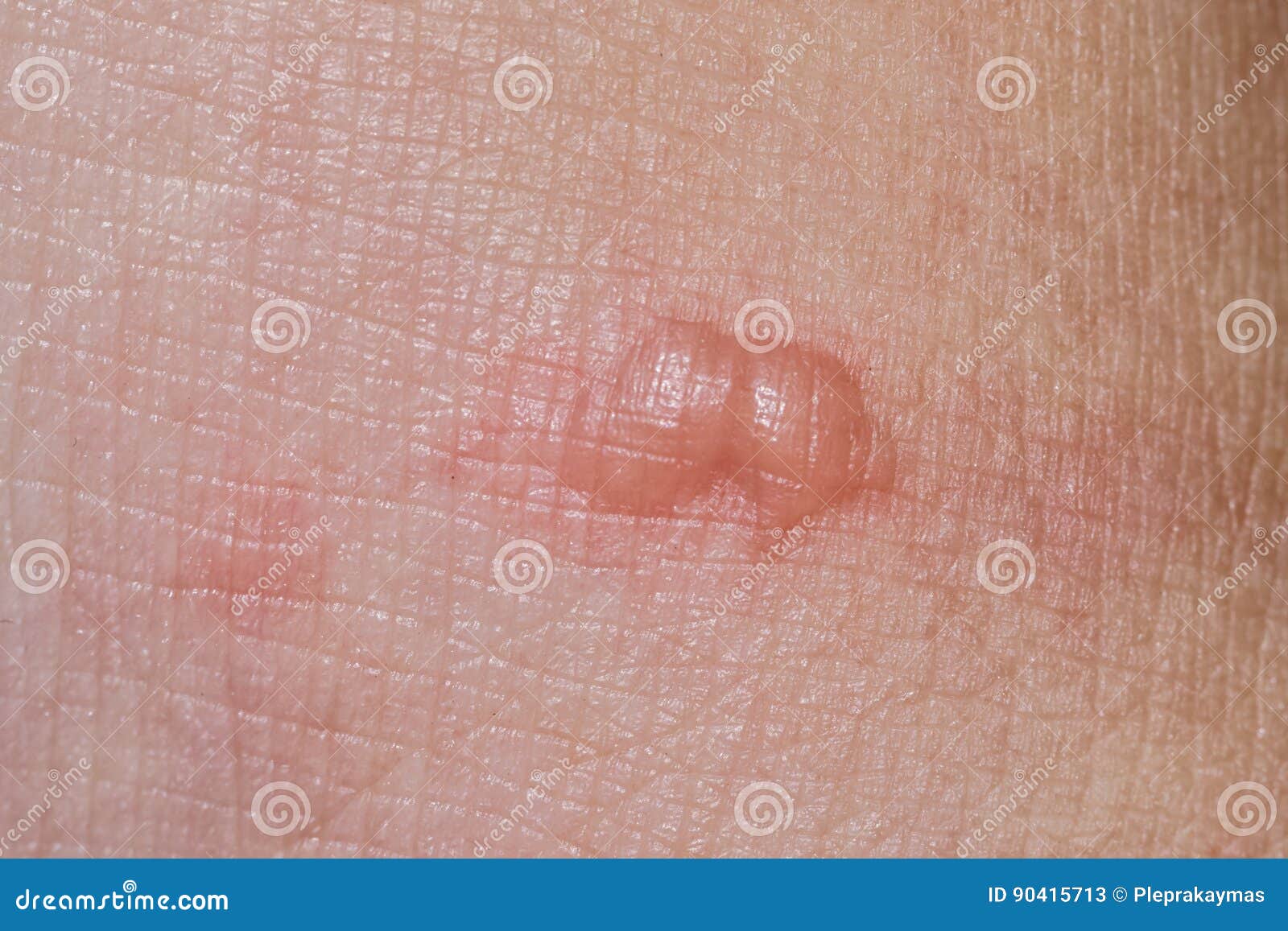Skin with Blisters.Burn Wound Skin Stock Image Image of callus