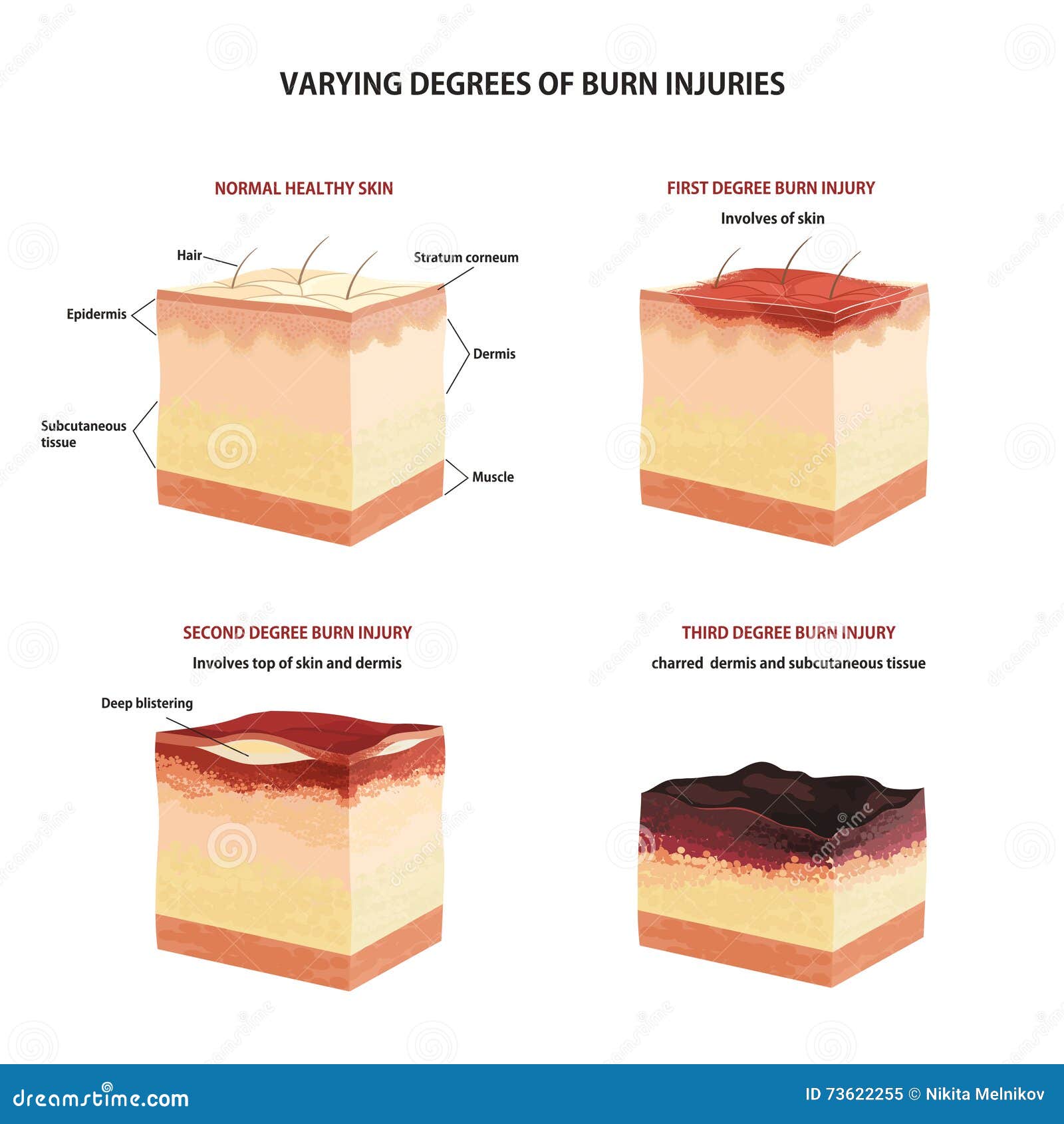 skin burn classification.