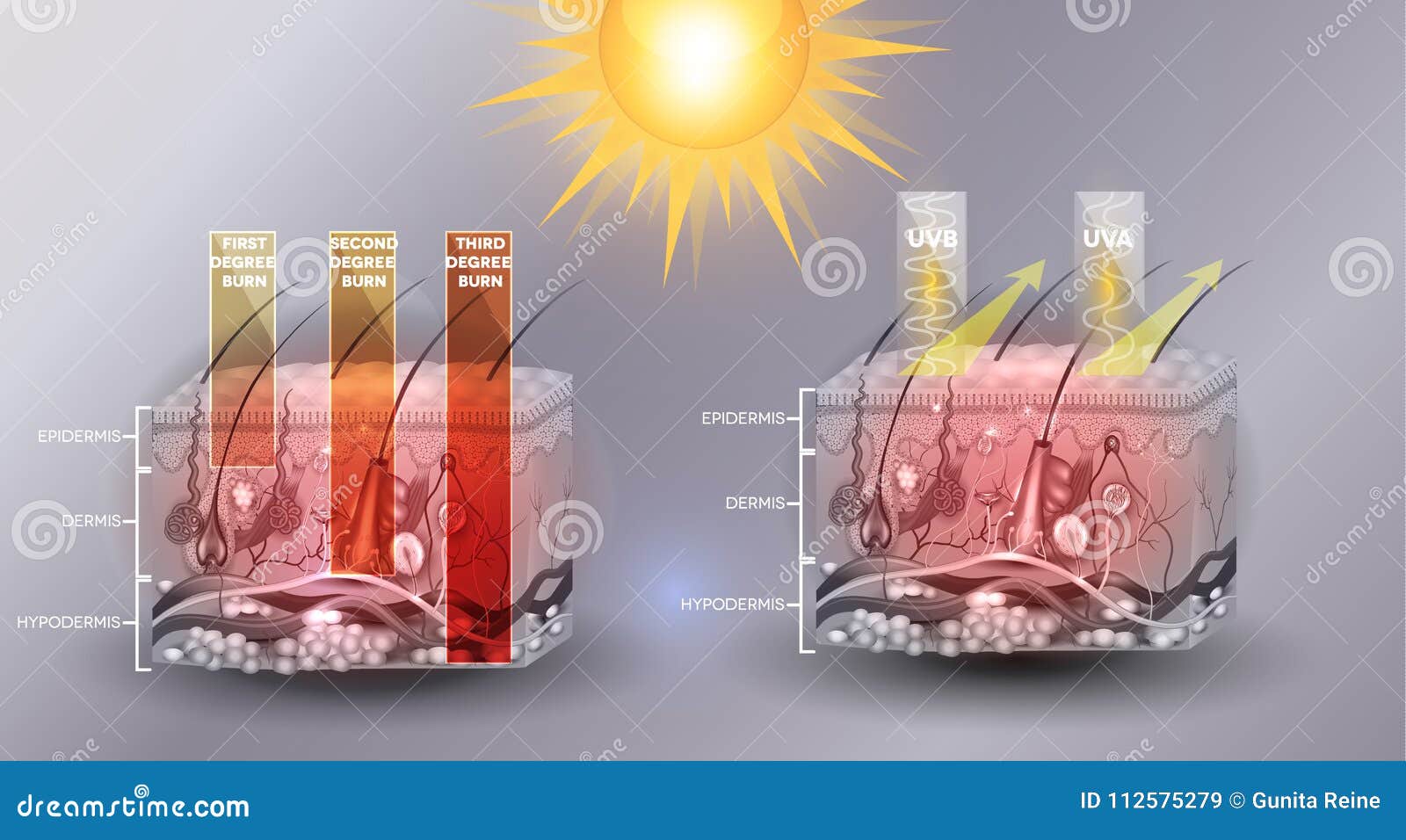 skin burn classification