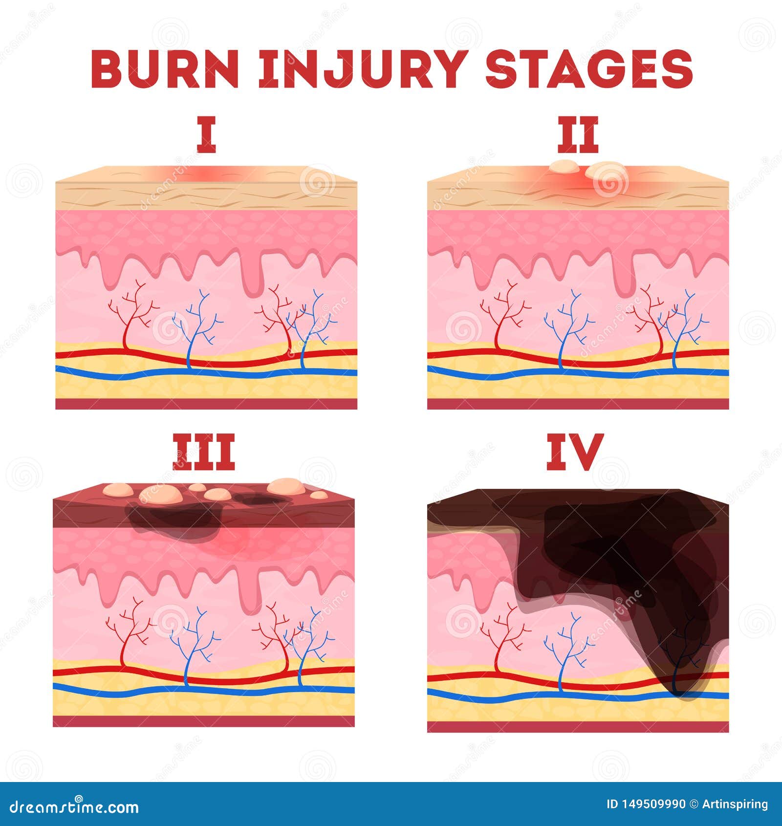 Skin Burn Injury Stages. Anatomy of the Skin. Stock Vector