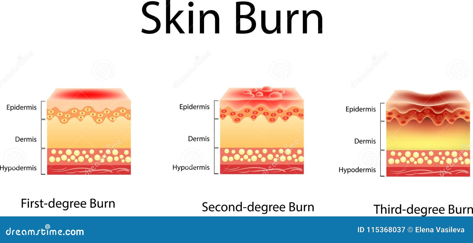 skin burn. three degrees of burns. type of injury to skin,  