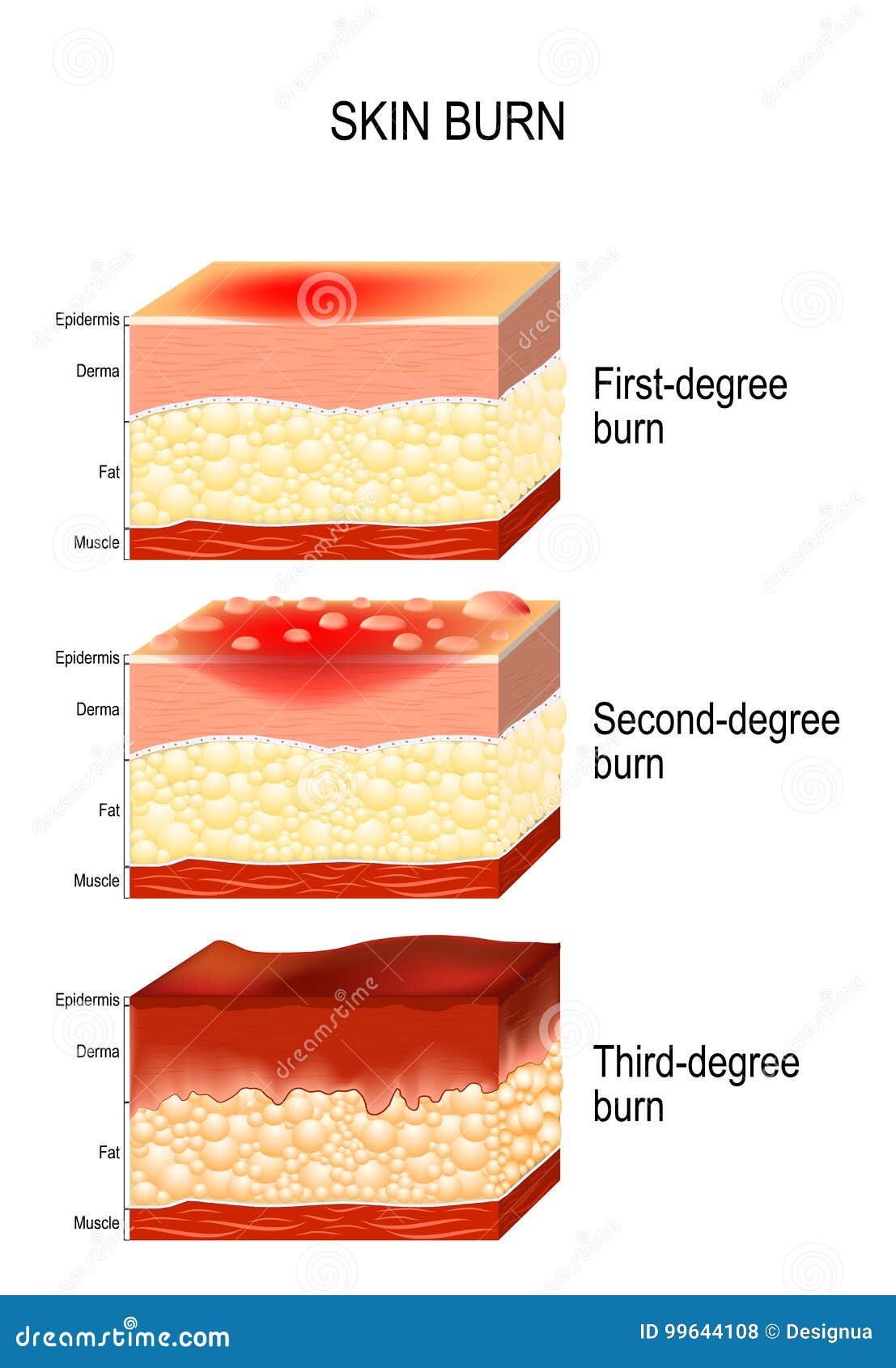 skin burn. three degrees of burns.