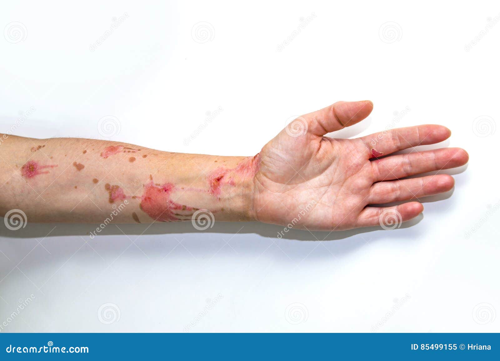 Skin Burns On Human Arm Stock Image Image Of Medicine 85499155