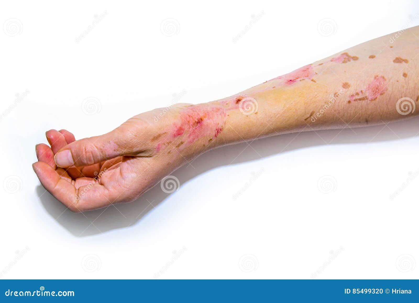 Skin burns on human arm stock photo. Image of people 85499320