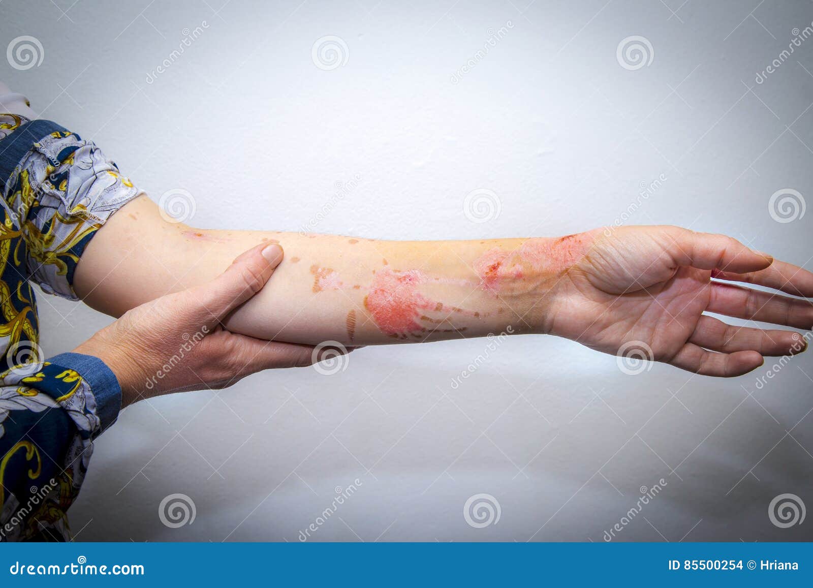 Skin burns on human arm stock photo. Image of human, flesh 85500254