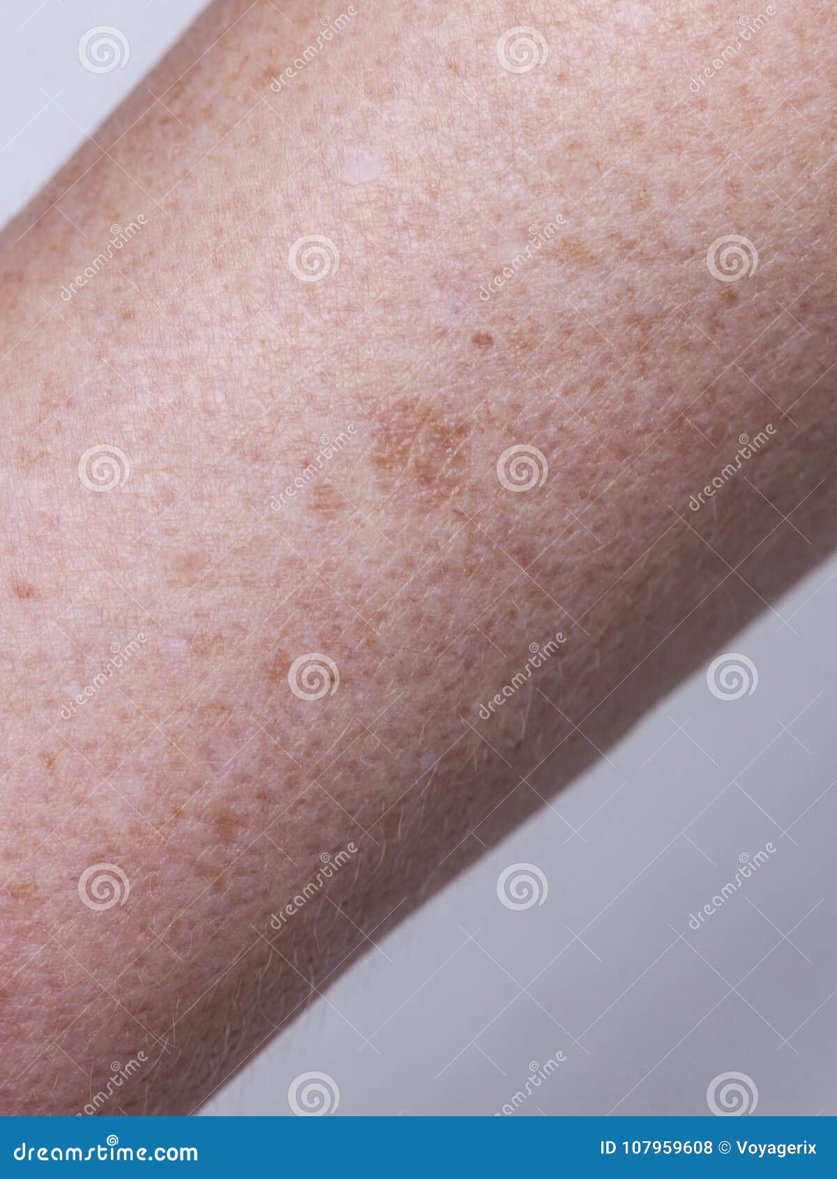 skin complexion discoloration, hyperpigmentation close up