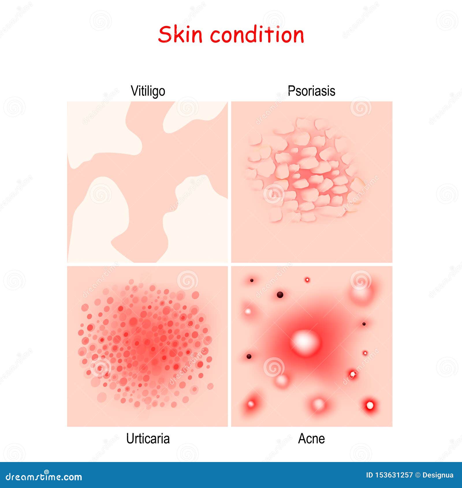 skin condition and diseases. close-up of acne, urticaria, psoriasis, vitiligo