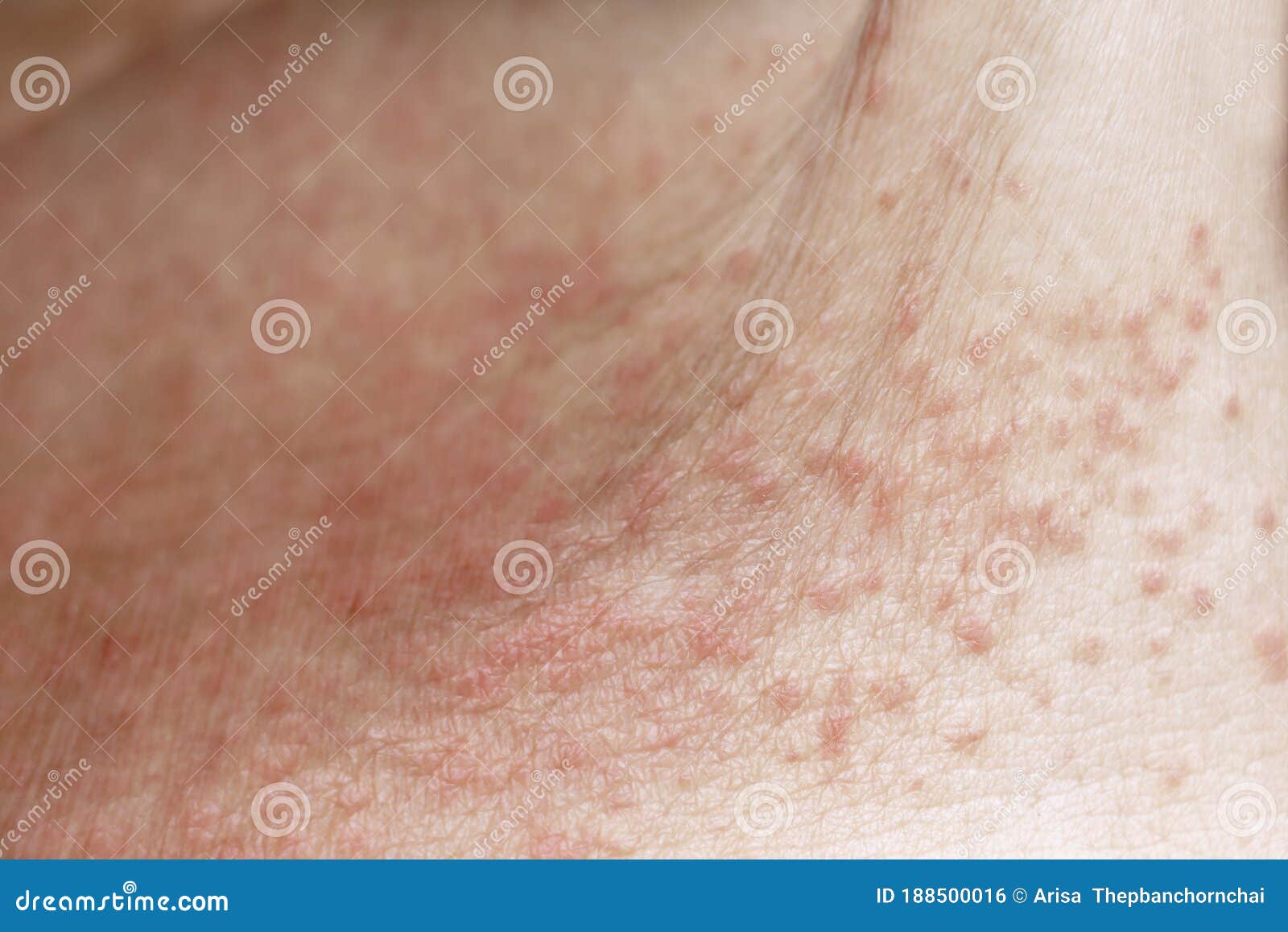 Skin Disease Prickly Heat Rash or Miliaria on Belly Skin of Woman