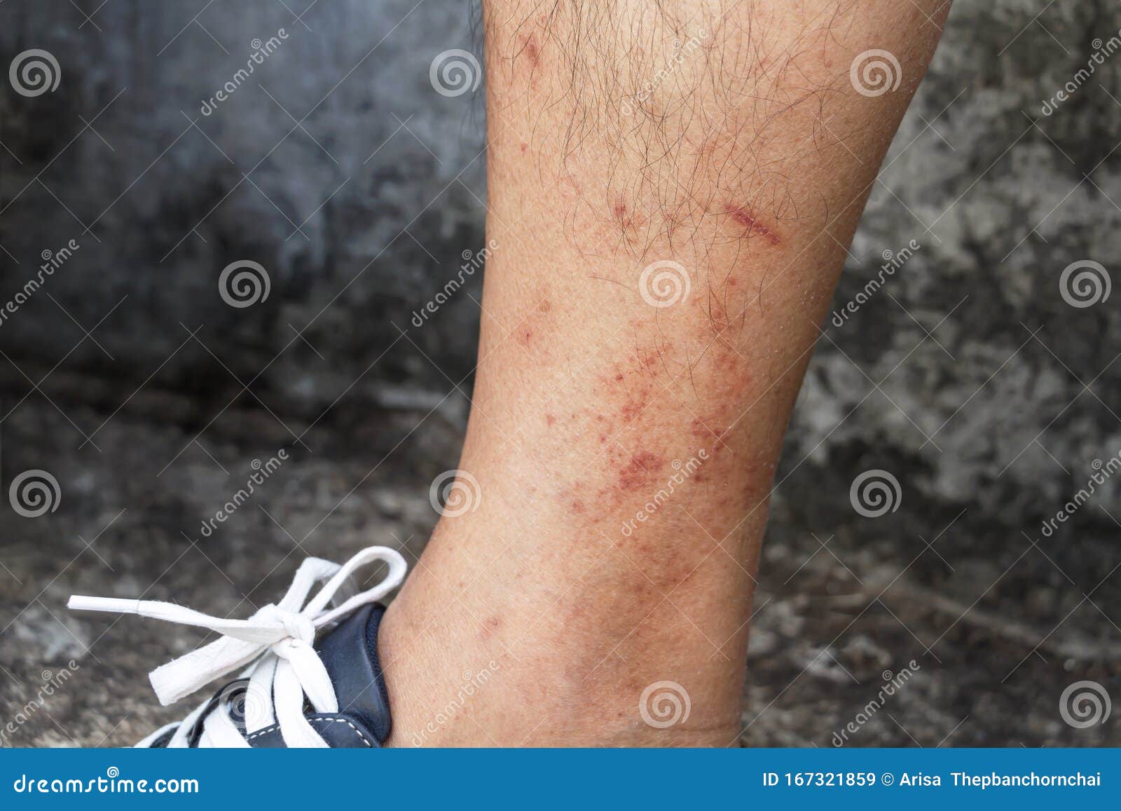 Skin Disease Winter Healthcare Dry Cracking Skin And Rash Red Of Leg