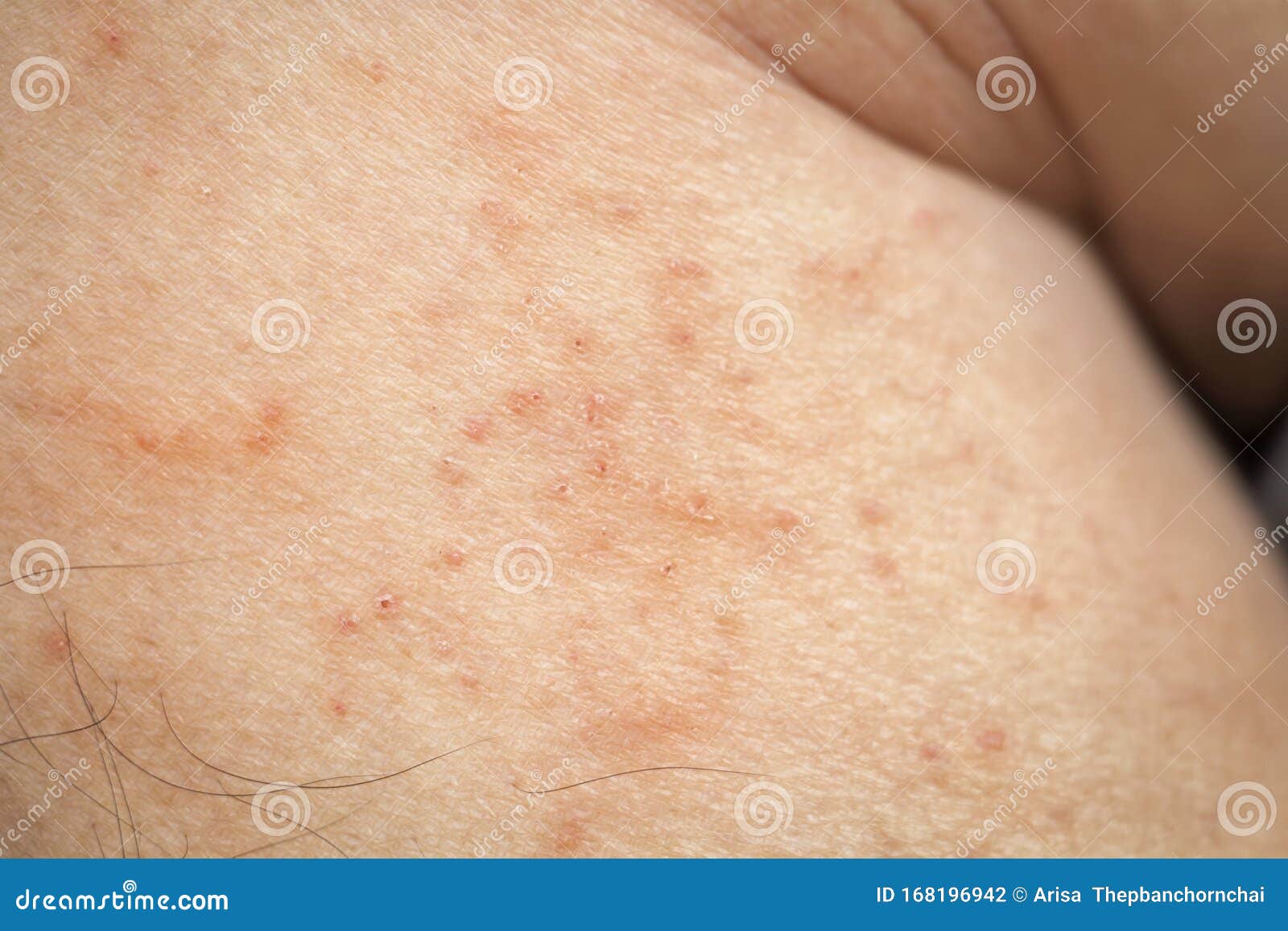 Skin Disease Winter Healthcare Dry Cracking Skin And Rash Red Of Leg