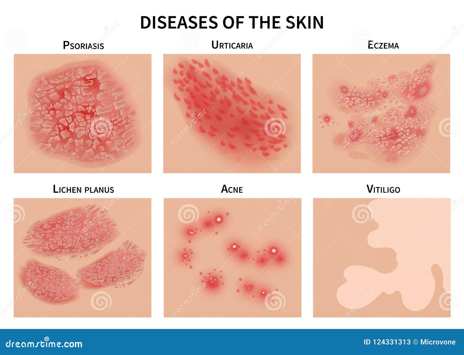 skin diseases. derma infection, eczema and psoriasis. dermatology  