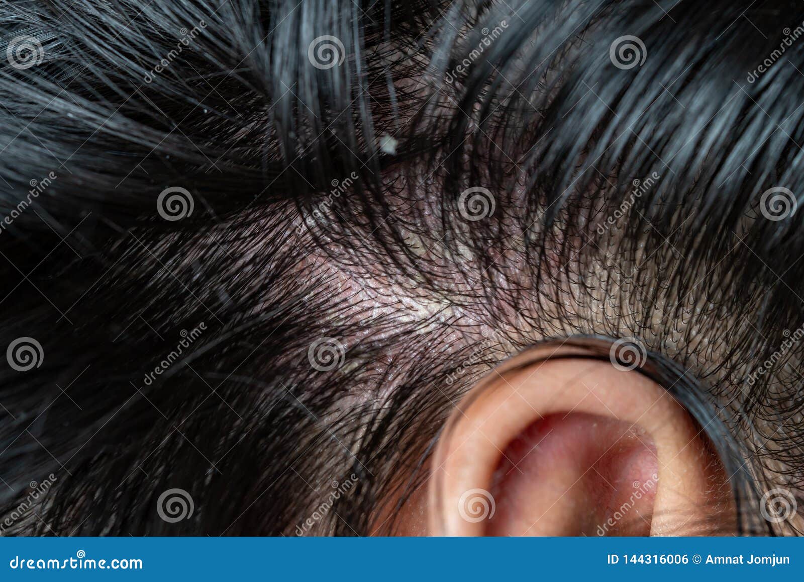 Skin Diseases, on the Scalp Stock Photo - Image of dandruff, itch ...