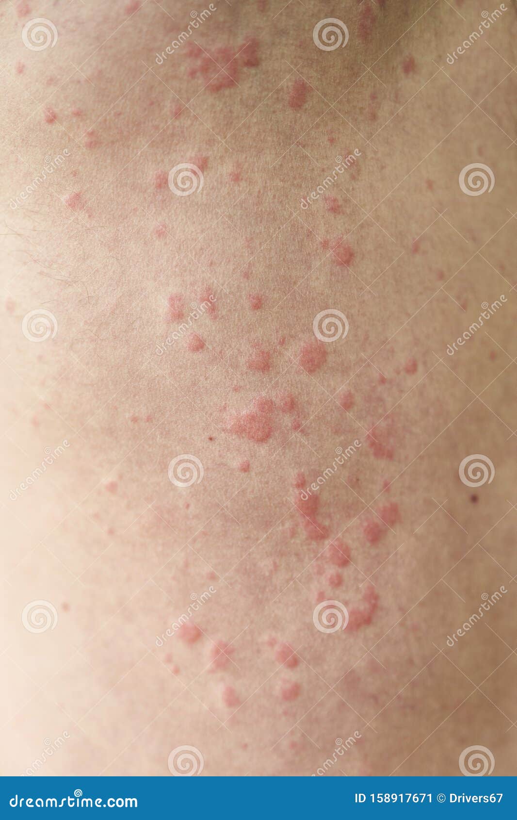 Skin Imperfection Skin Allergy Urticaria Disease Red Spots On The