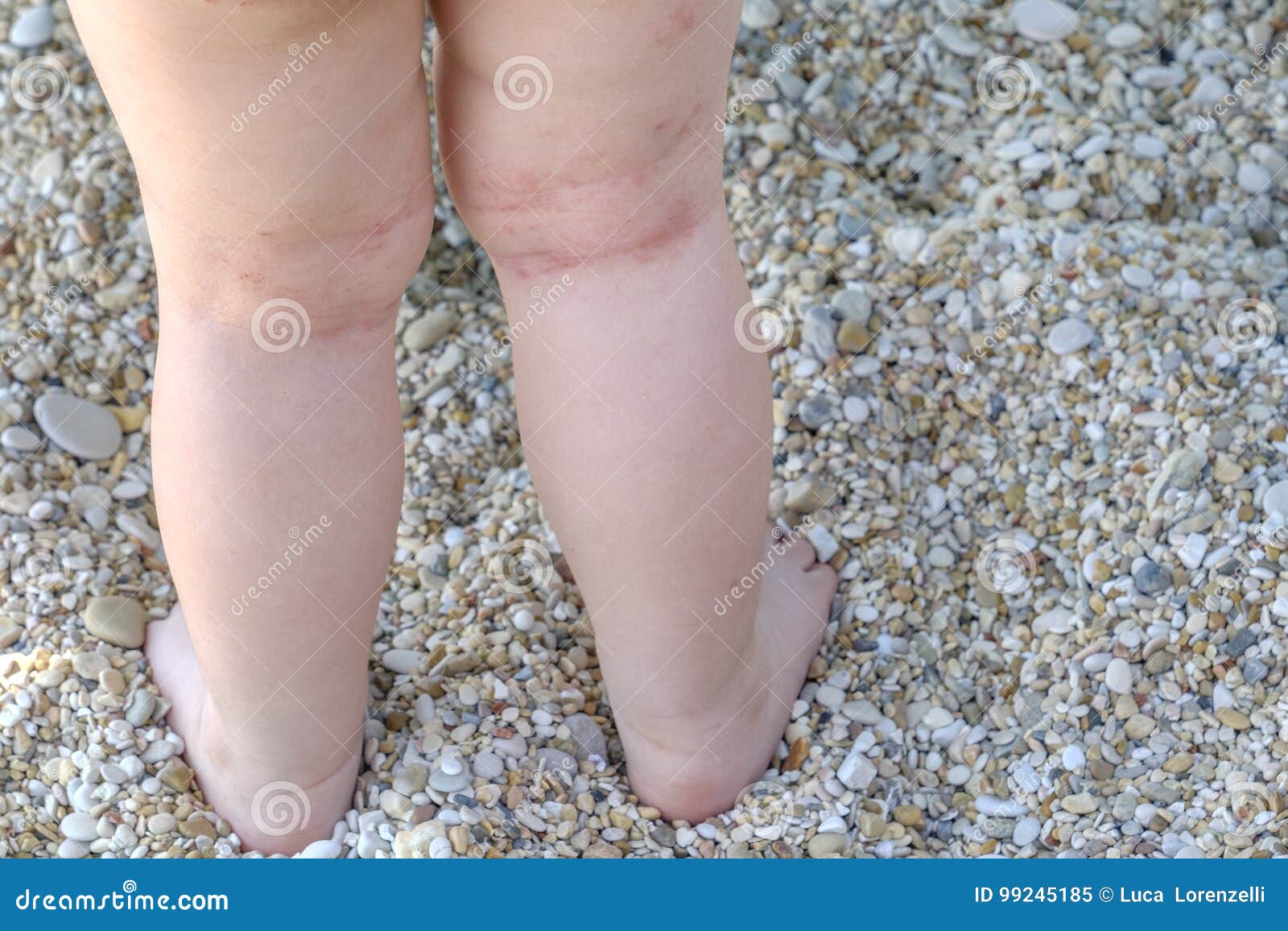 skin irritation newborn atopic dermatitis legs