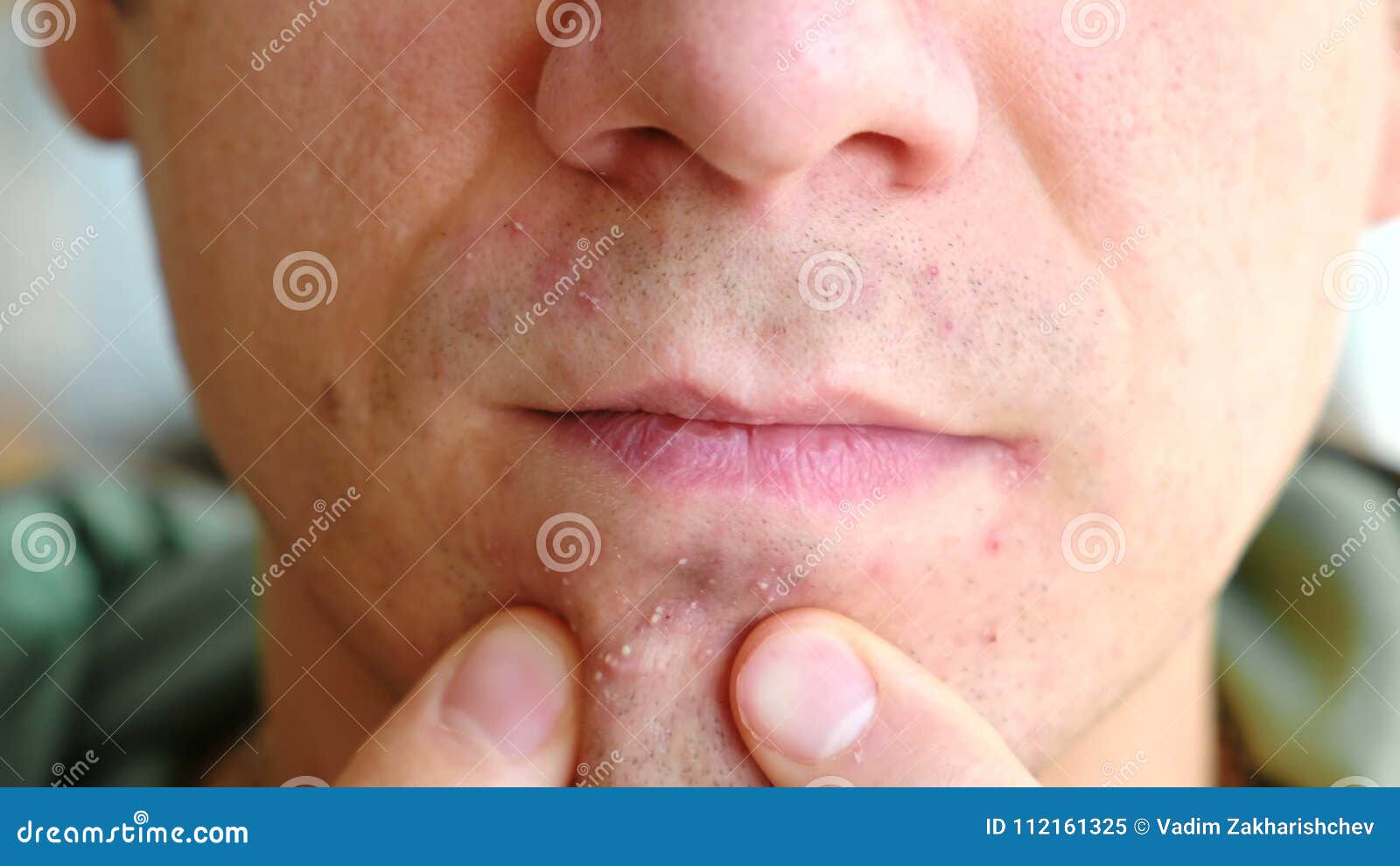 Skin Irritation After Shaving Man`s Hands Squeeze Pimples On The Chin