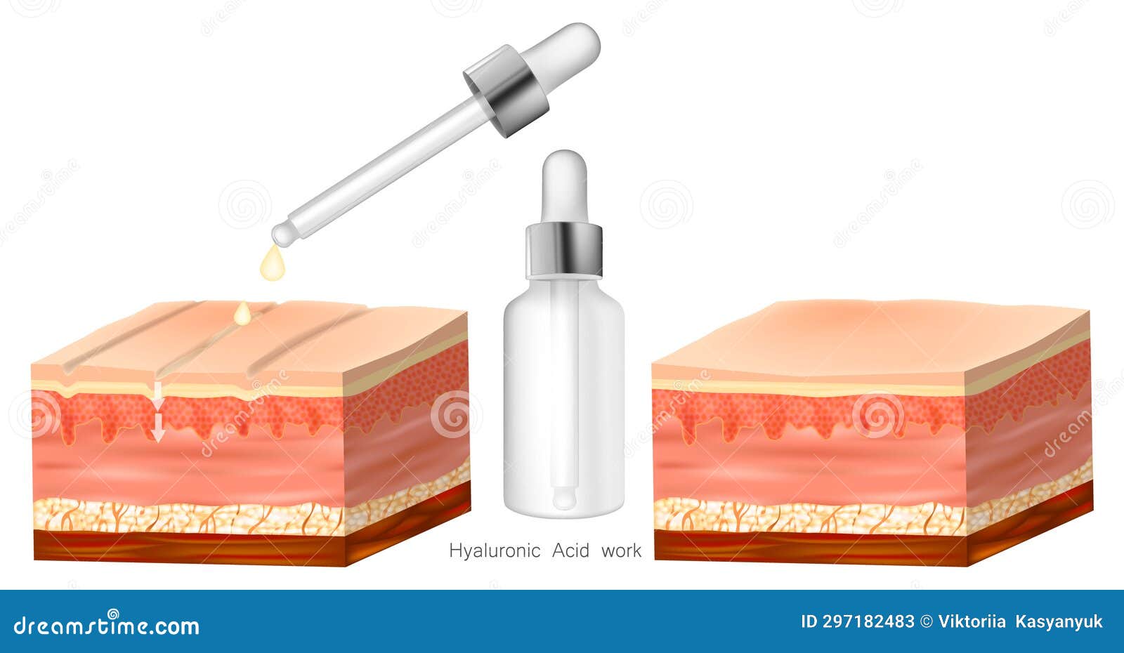 Skin Layer Getting Hyaluronic Acid. before Ad after. Hyaluronic Acid