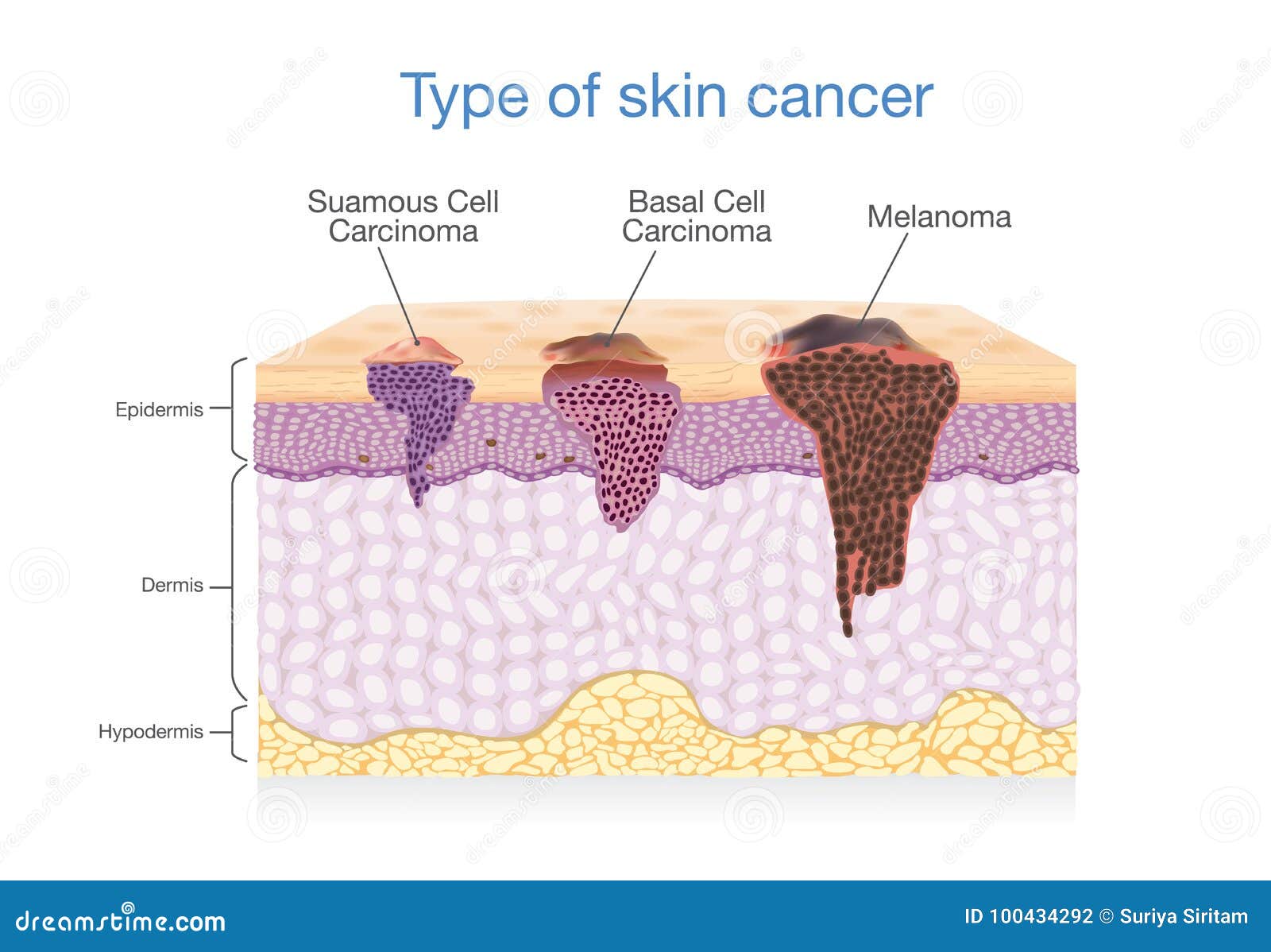 Skin Layer Have 3 Type Of Cancer In One Stock Vector Illustration Of