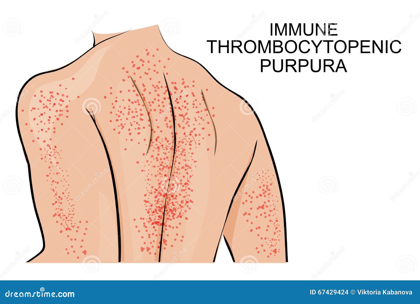 the skin lesions in immune thrombocytopenic purpura