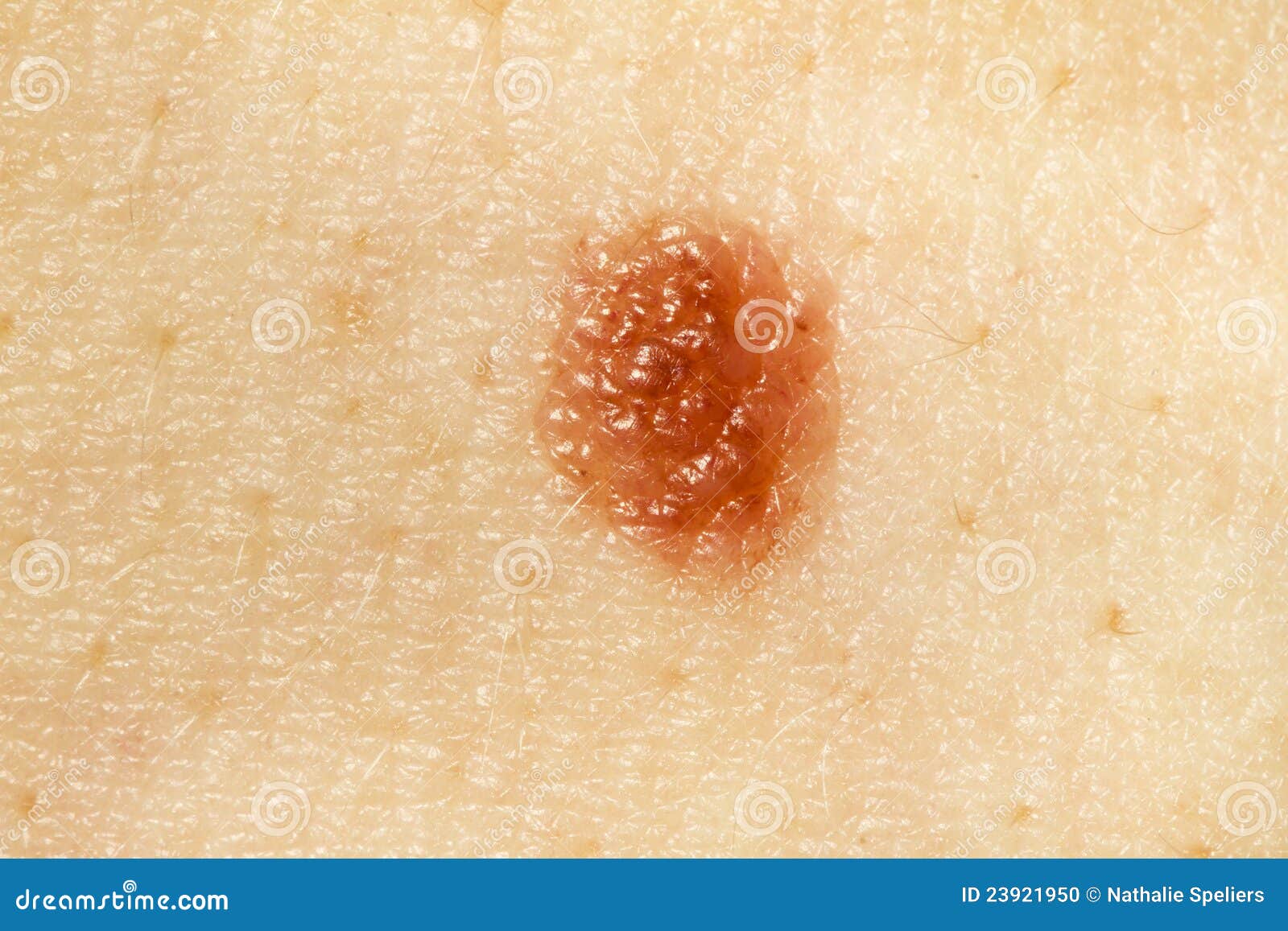 Melanoma Warning Signs and Images - SkinCancer.org