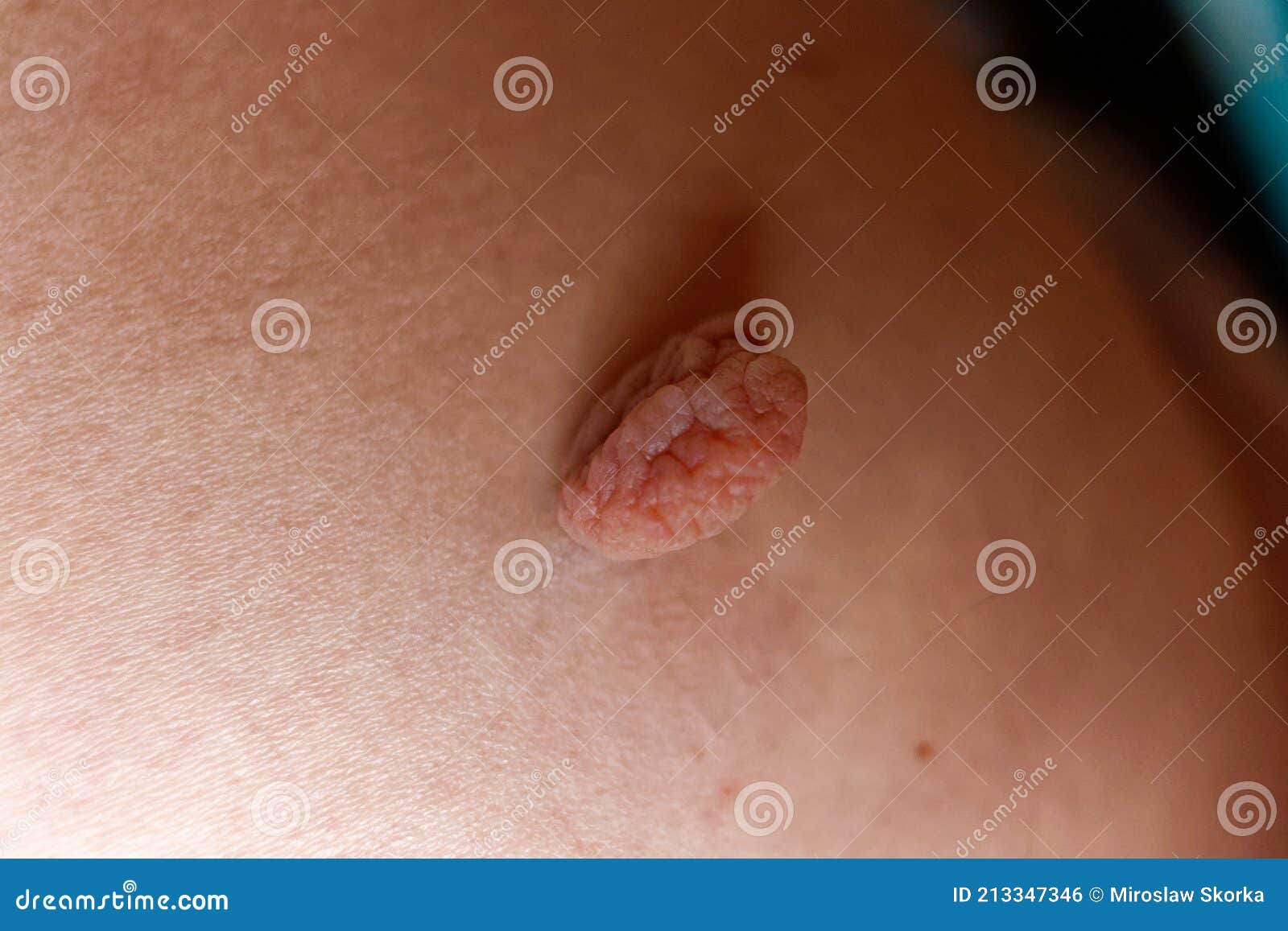 skin nodule on a buttock