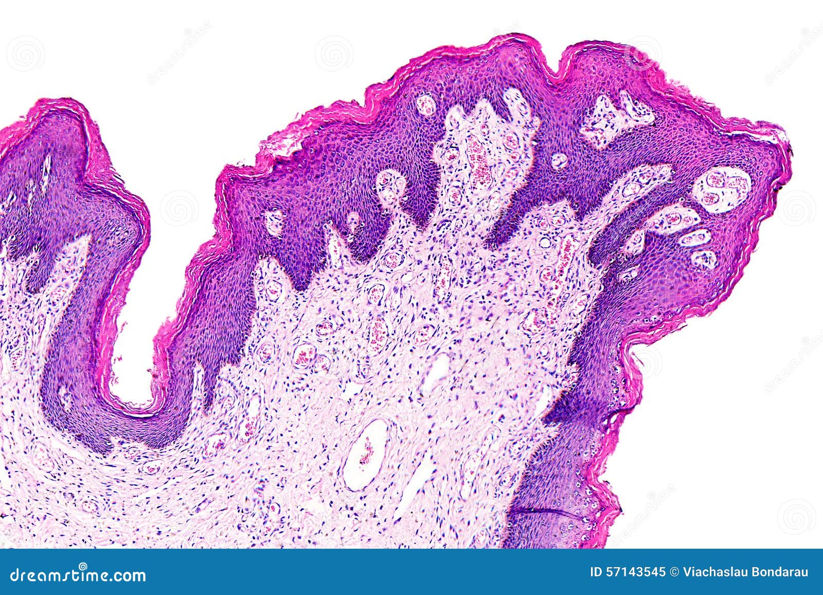 Microscop papilom Papilom la microscop, HPV (Papiloma Virus Uman) E6/E7 ARNm
