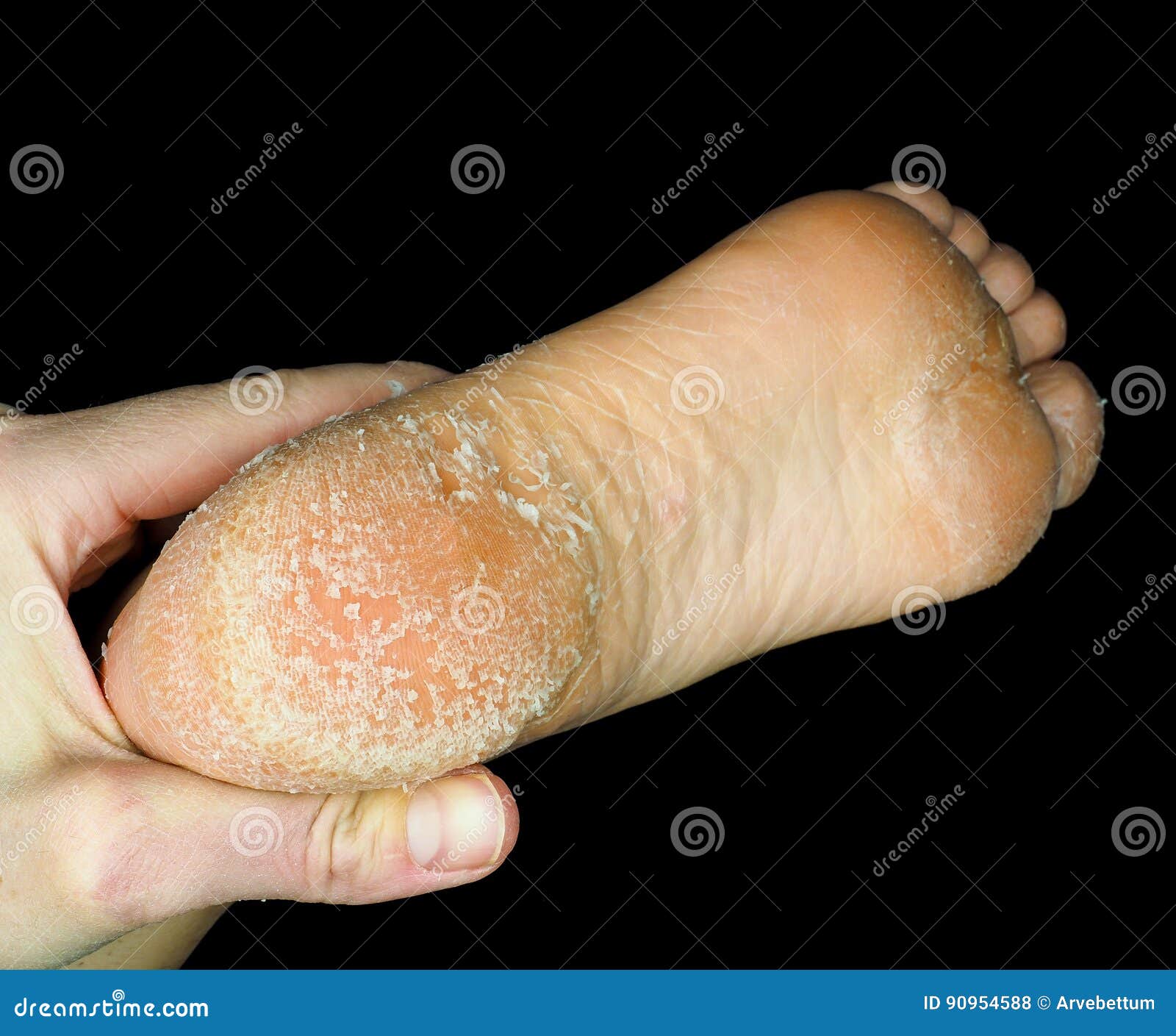 Foot Peel Stock Image 76552003