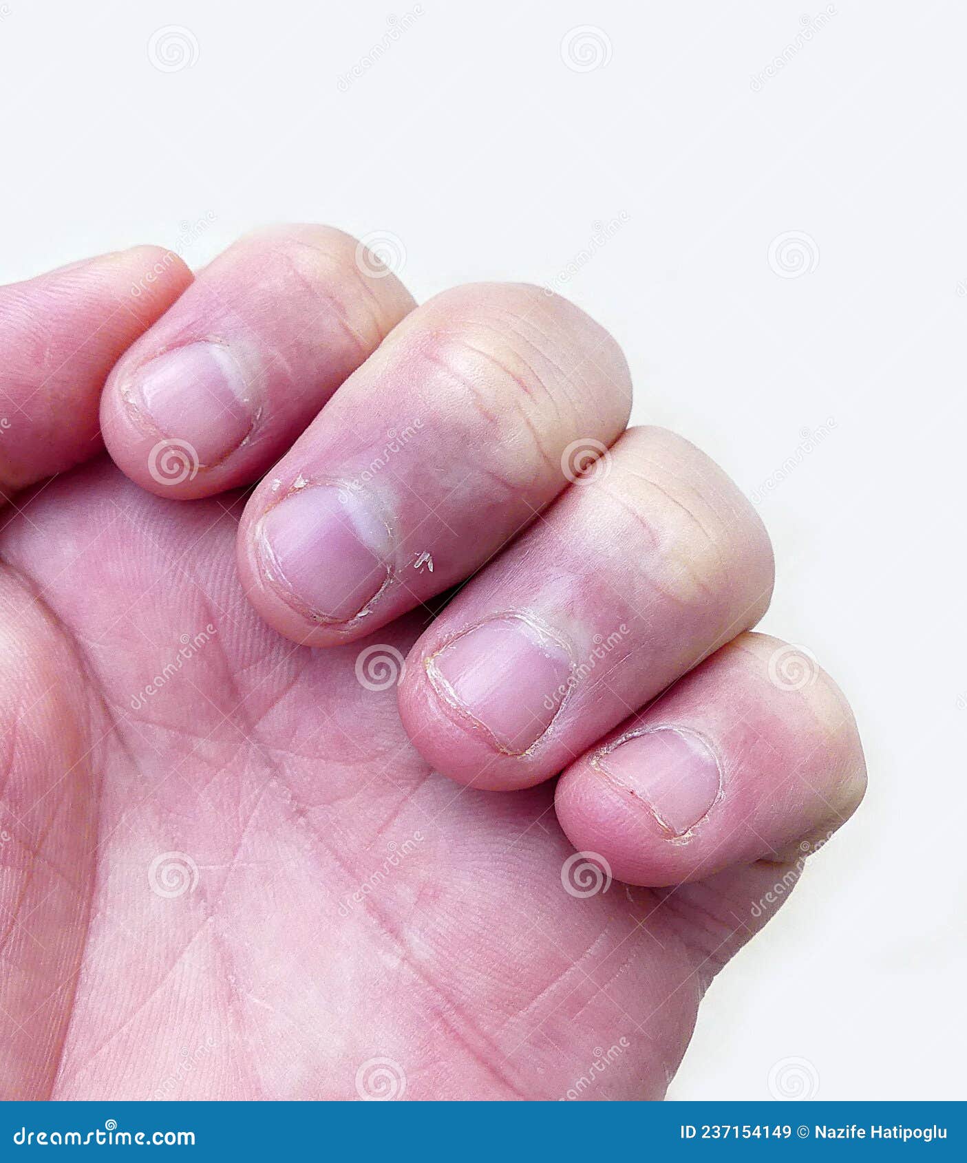 Skin Peeling on Finger Nails, Vitamin C Deficiency and Nail Skin Diseases  Stock Image - Image of glass, beauty: 237154149