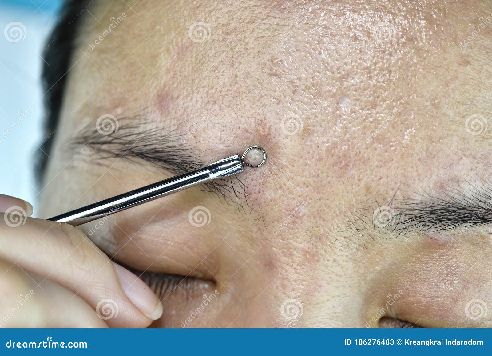 skin problem with acne diseases, close up woman face squeezing whitehead pimples with acne removal tool.
