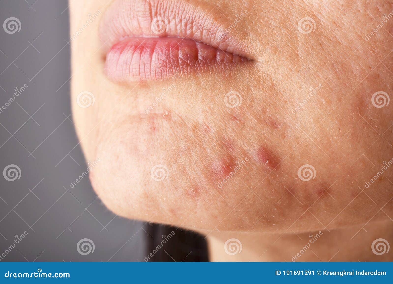 skin problem with acne diseases, close up woman face with whitehead pimples on chin, menstruation breakout