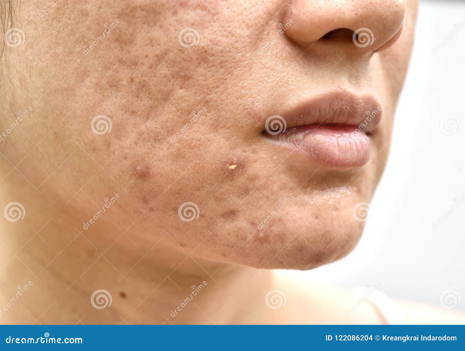 skin problem with acne diseases, close up woman face with whitehead pimples, menstruation breakout, scar and oily greasy face.