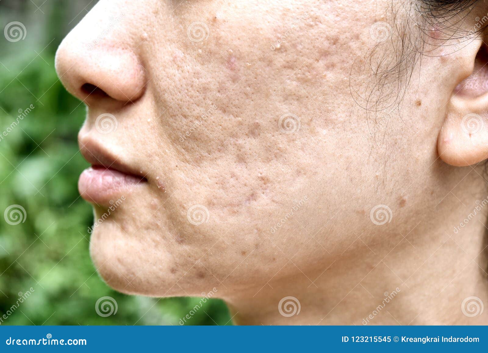 skin problem with acne diseases, close up woman face with whitehead pimples, menstruation breakout.