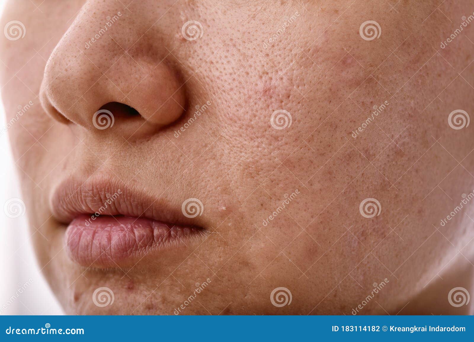 skin problem with acne diseases, close up woman face with whitehead pimples on mouth.