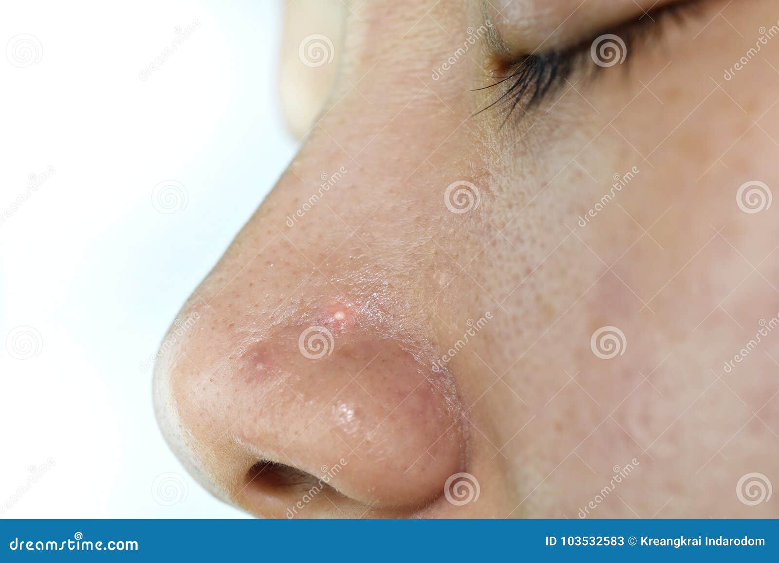 skin problem with acne diseases, close up woman scar face with whitehead pimples on nose.