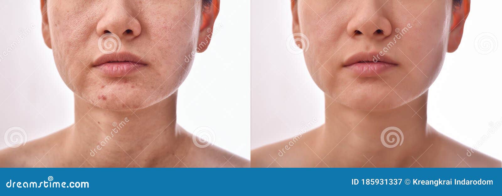 skin problems and acne scar, before and after acne facial care treatment