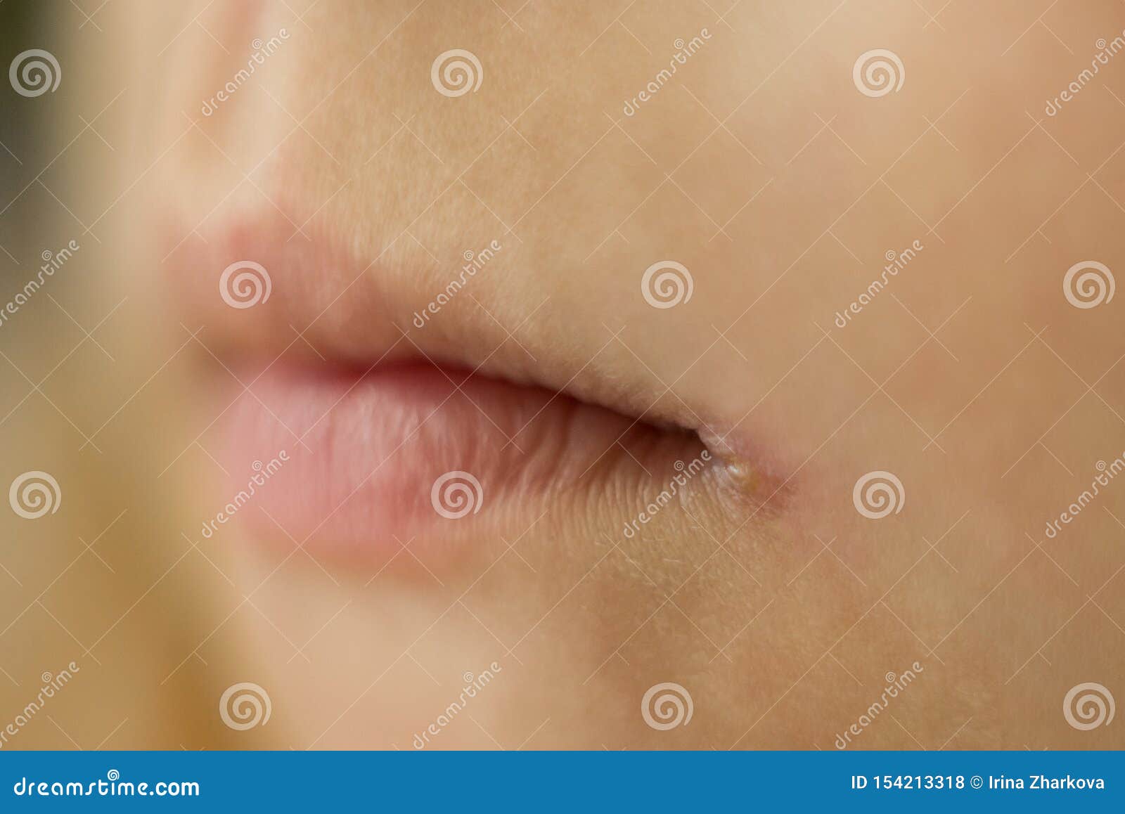 skin problems, angulitis, a disease of the mucous membrane and skin of the corners of the mouth, caused by streptococci