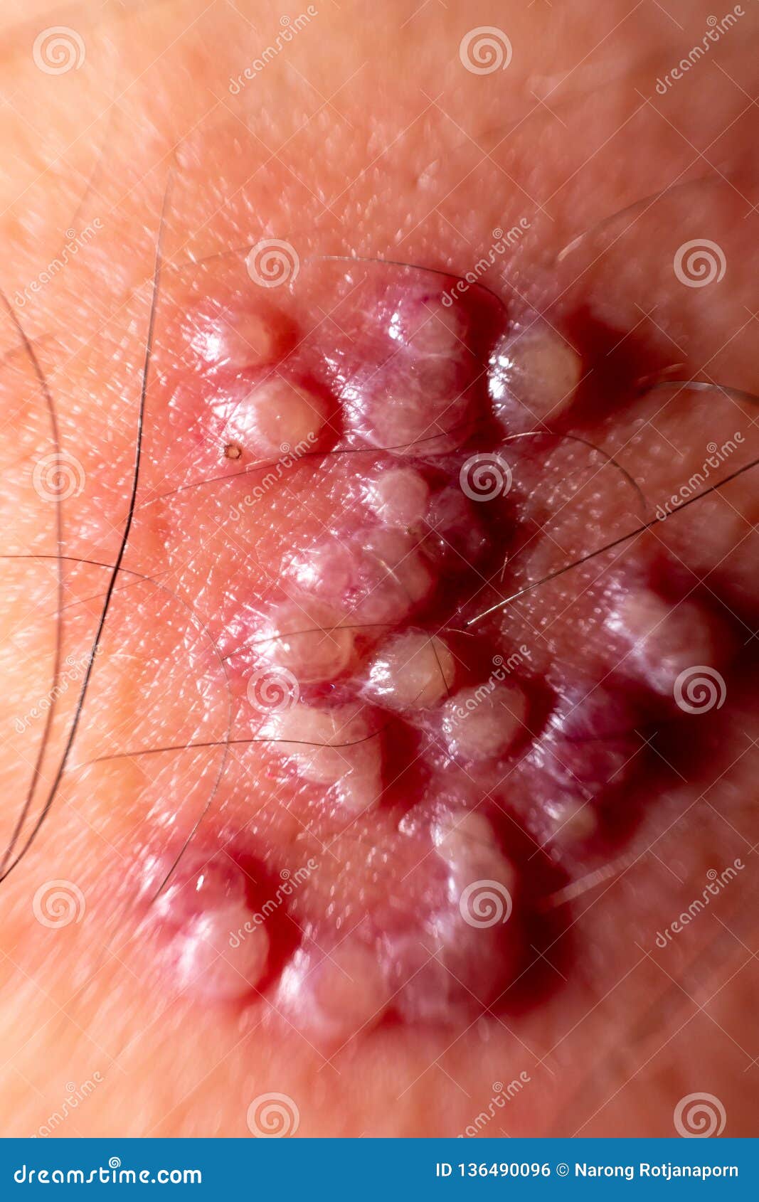 skin rash and blisters on body. shingles on men herpes zoster