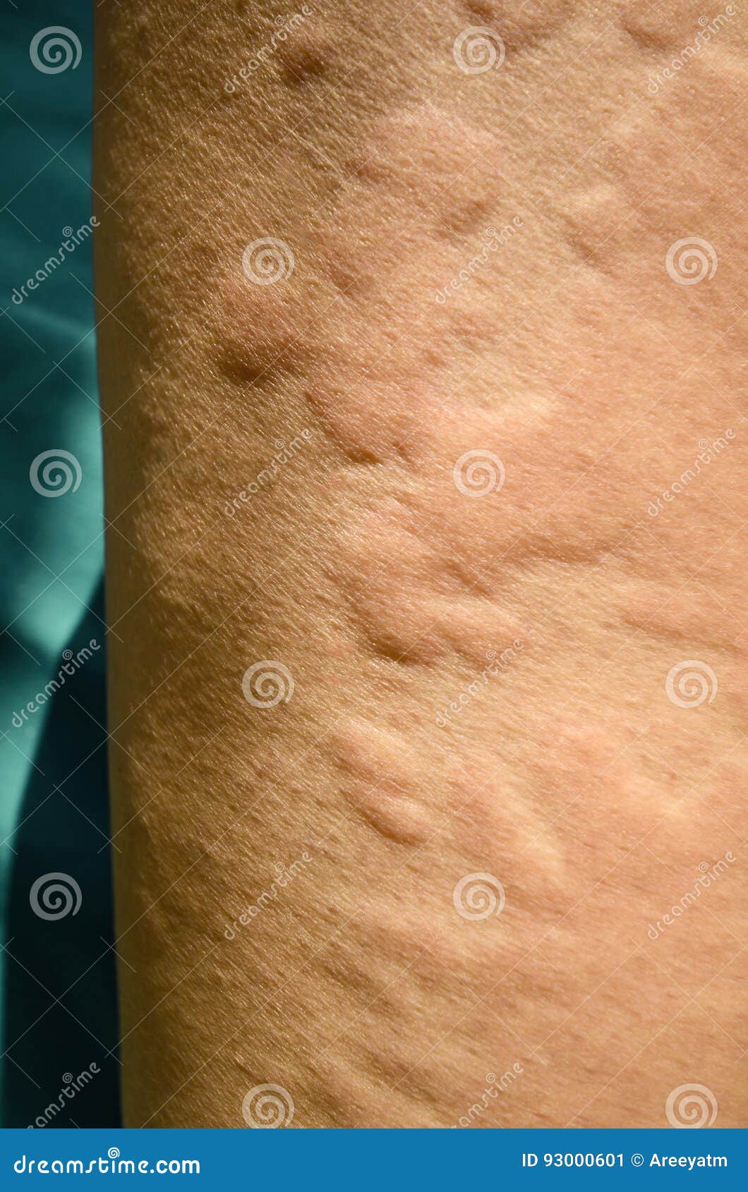 skin rash, urticaria, allergic skin reaction.