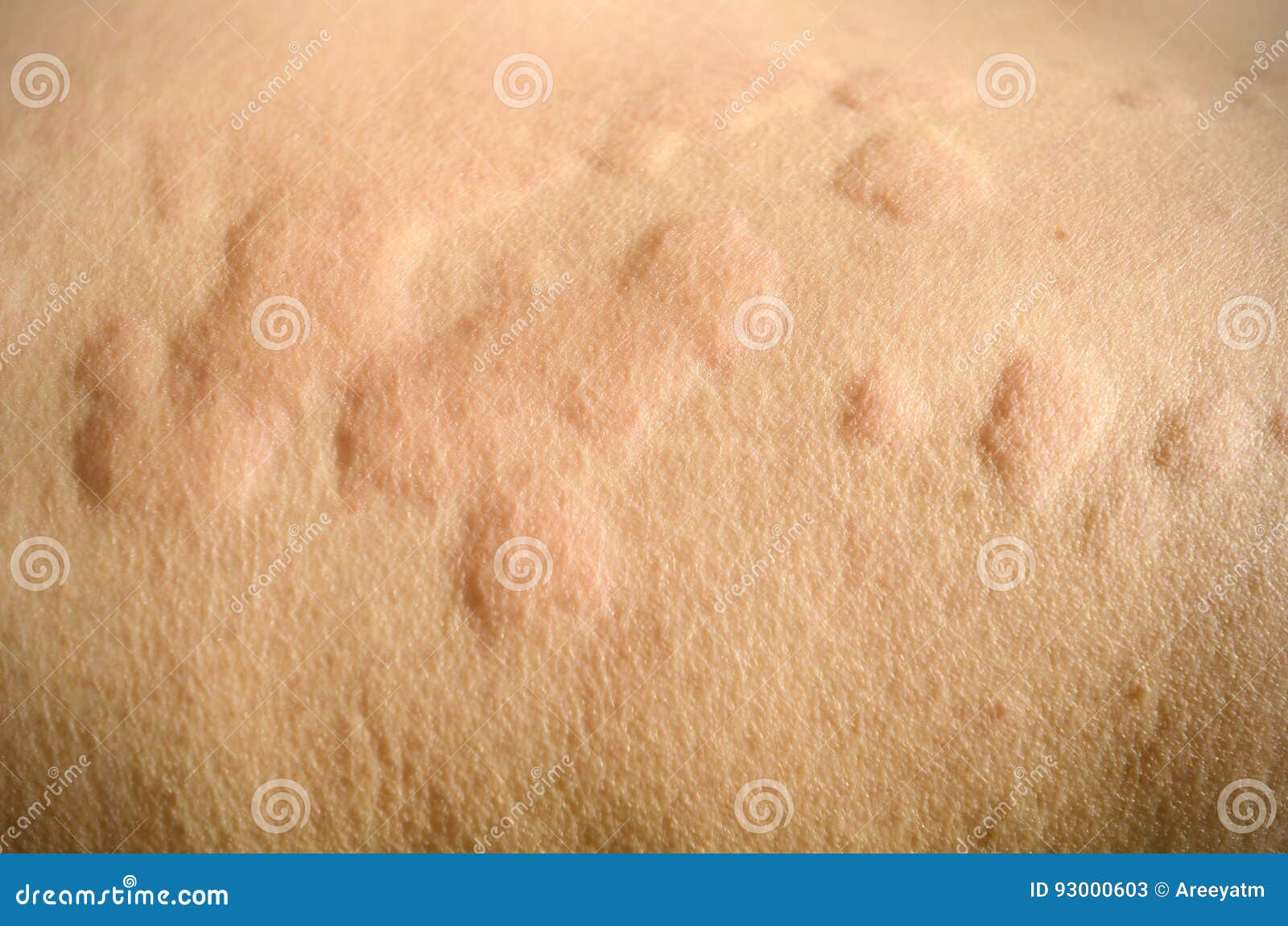 skin rash, urticaria, allergic skin reaction.