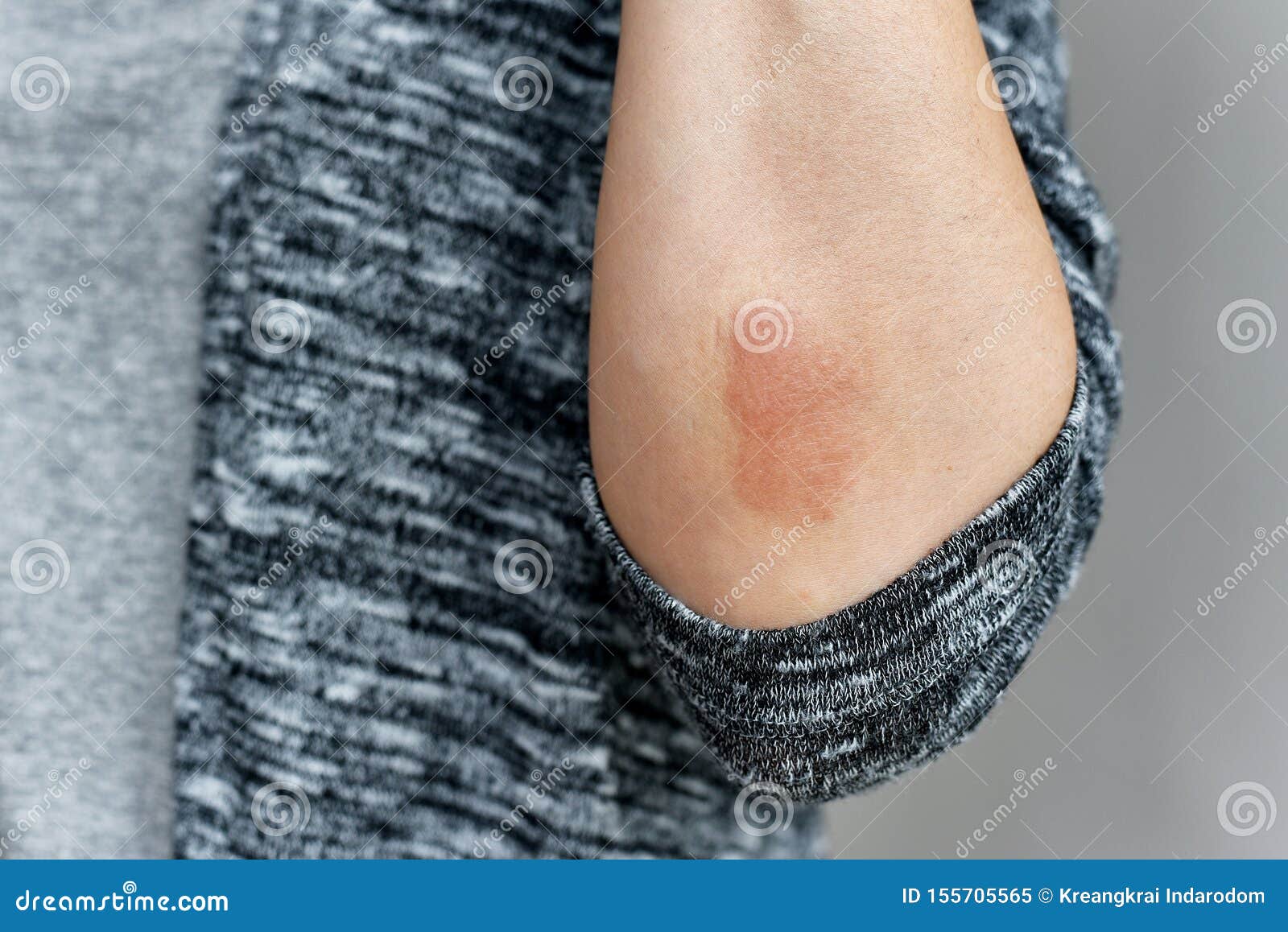 Skin irritation arm hi-res stock photography and images - Page 2 - Alamy