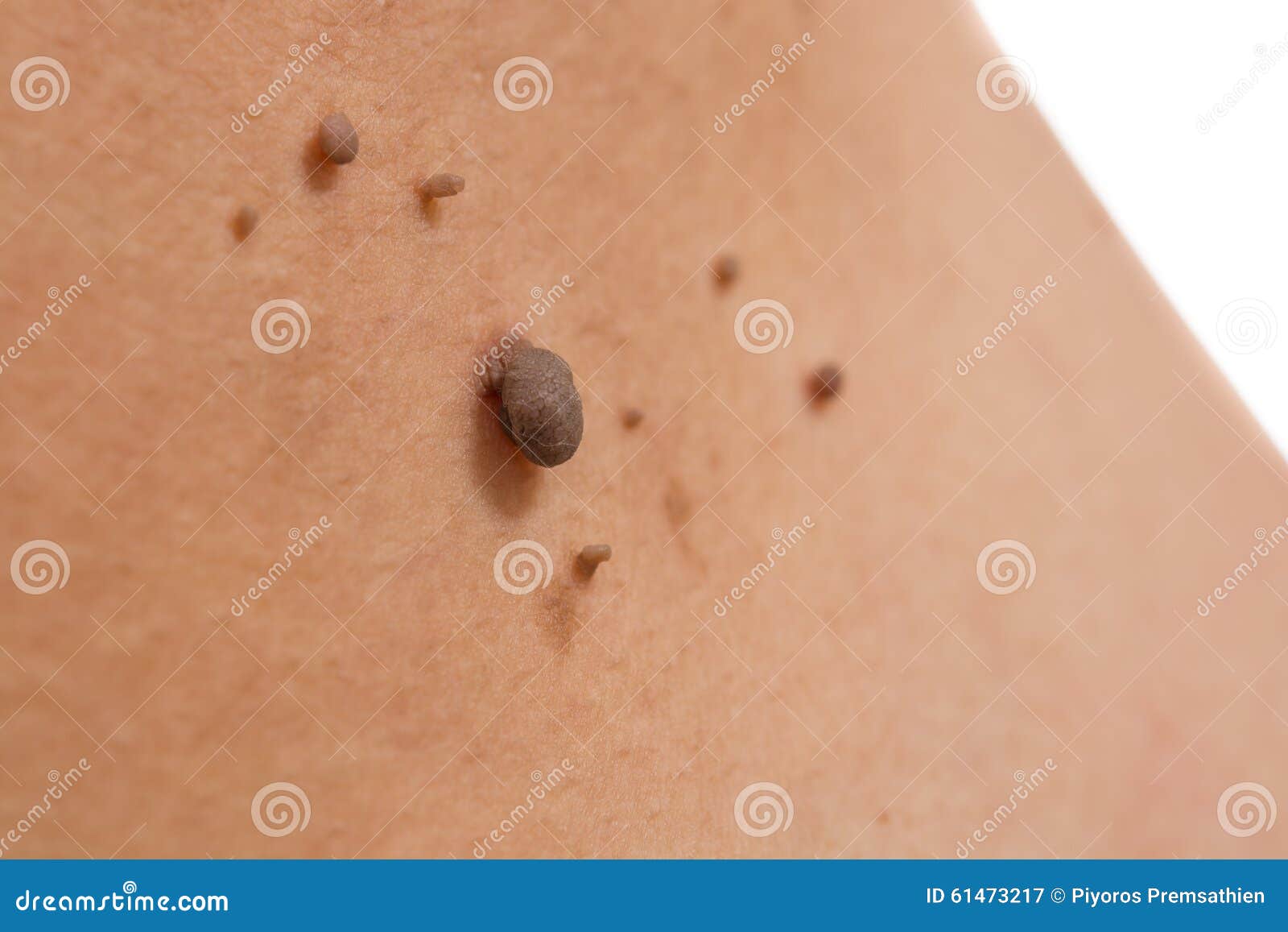 white moles on skin white moles on skin
