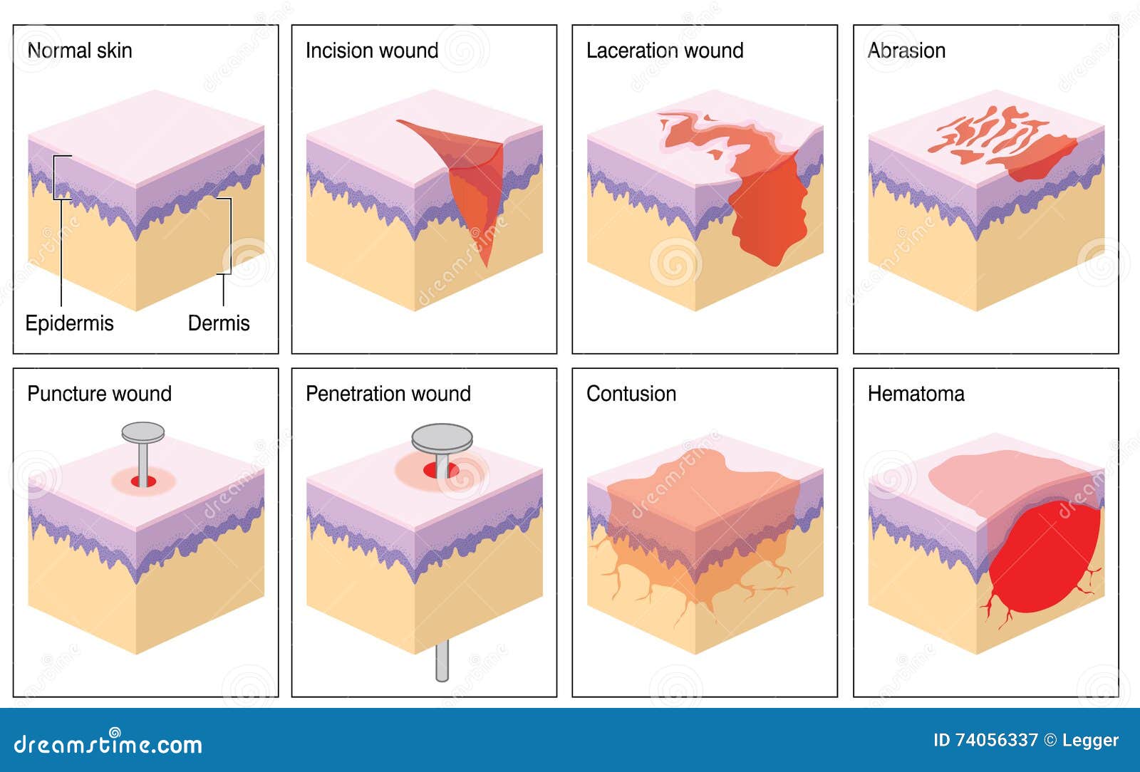 Skin Wound Types