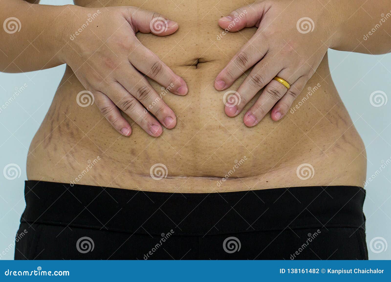 slim and fit figure after the longitudinal caesarean section. scar after a caesarean section, bikini line.